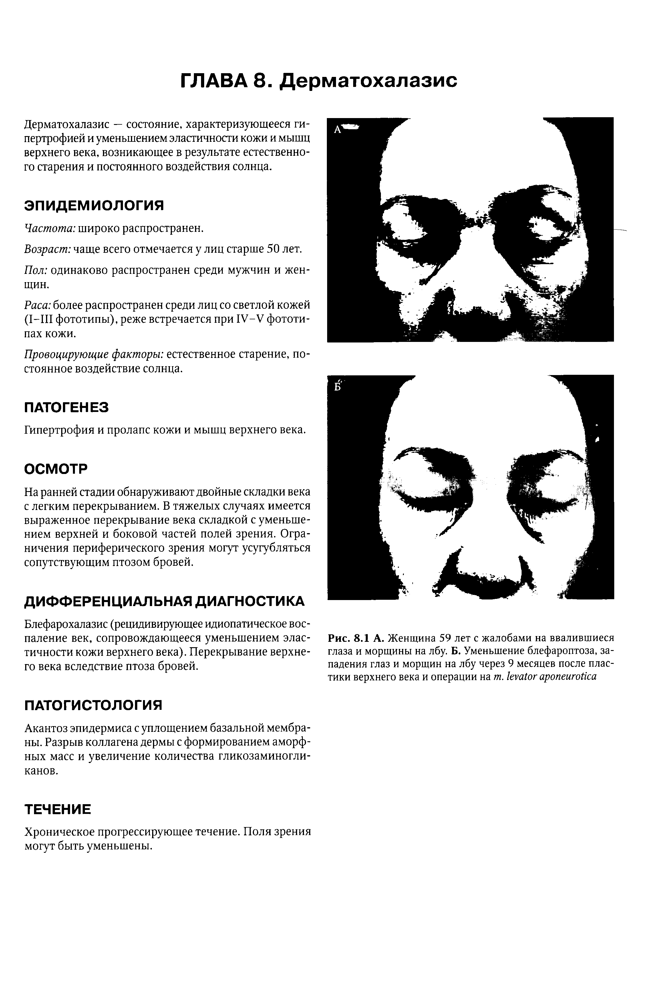 Рис. 8.1 А. Женщина 59 лет с жалобами на ввалившиеся глаза и морщины на лбу. Б. Уменьшение блефароптоза, западения глаз и морщин на лбу через 9 месяцев после пластики верхнего века и операции на т. ...