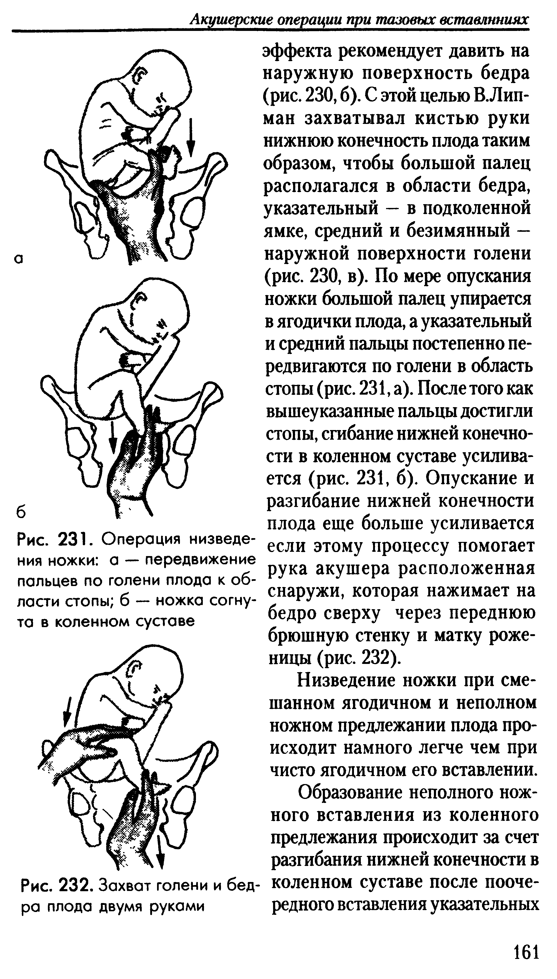 Рис. 231. Операция низведения ножки а — передвижение пальцев по голени плода к области стопы б ножка согнута в коленном суставе...