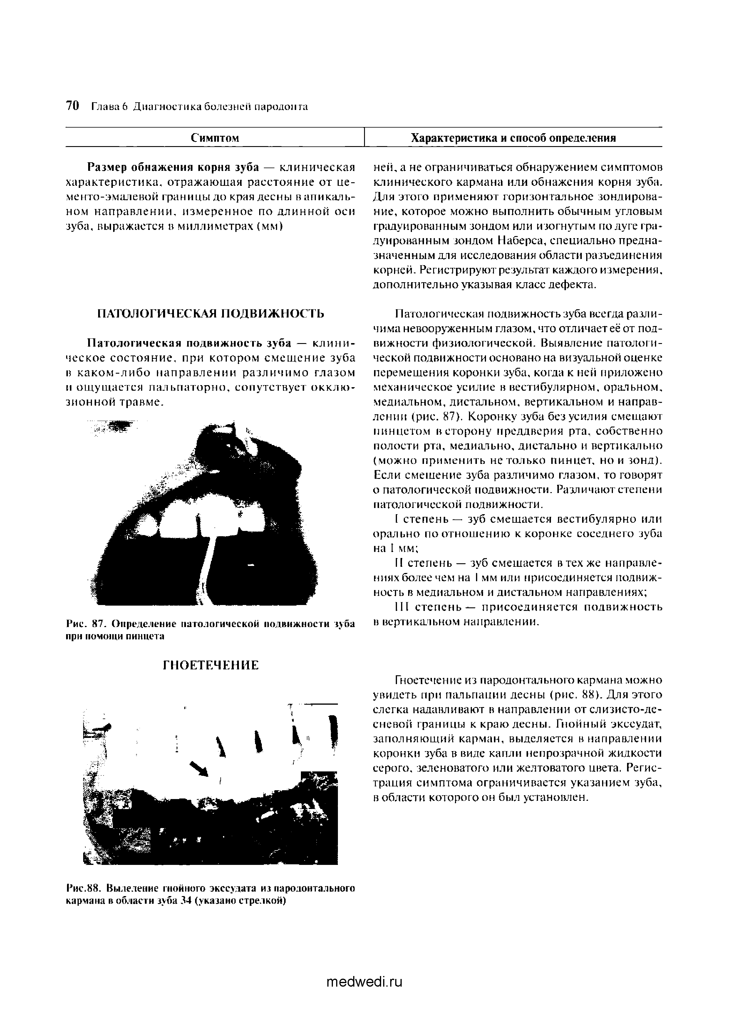 Рис. 87. Определение патологической подвижности зуба при помощи пинцета...