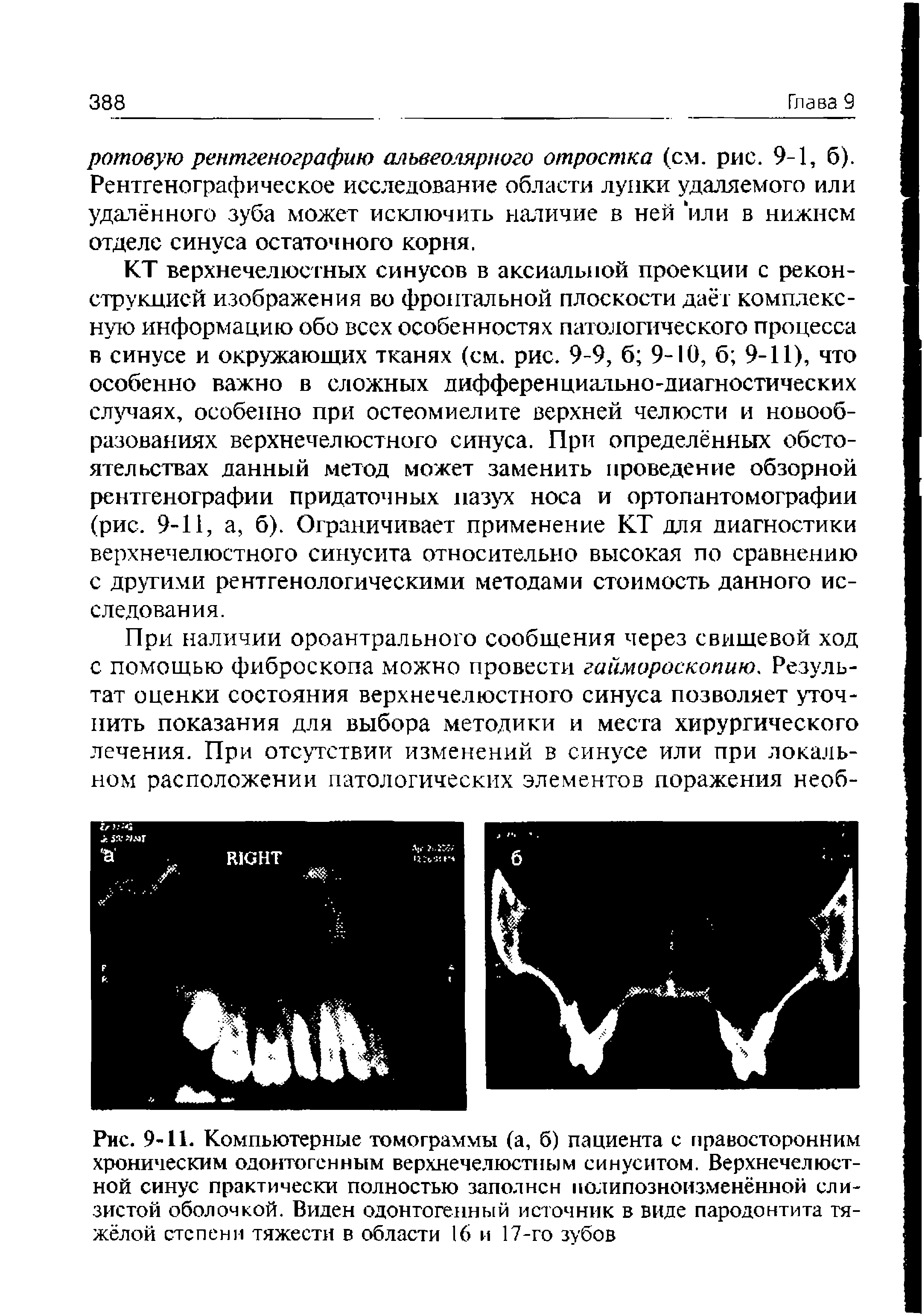 Рис. 9-11. Компьютерные томограммы (а, б) пациента с правосторонним хроническим одонтогенным верхнечелюстным синуситом. Верхнечелюстной синус практически полностью заполнен полипозноизменённой слизистой оболочкой. Виден одонтогенный источник в виде пародонтита тяжёлой степени тяжести в области 16 и 17-го зубов...