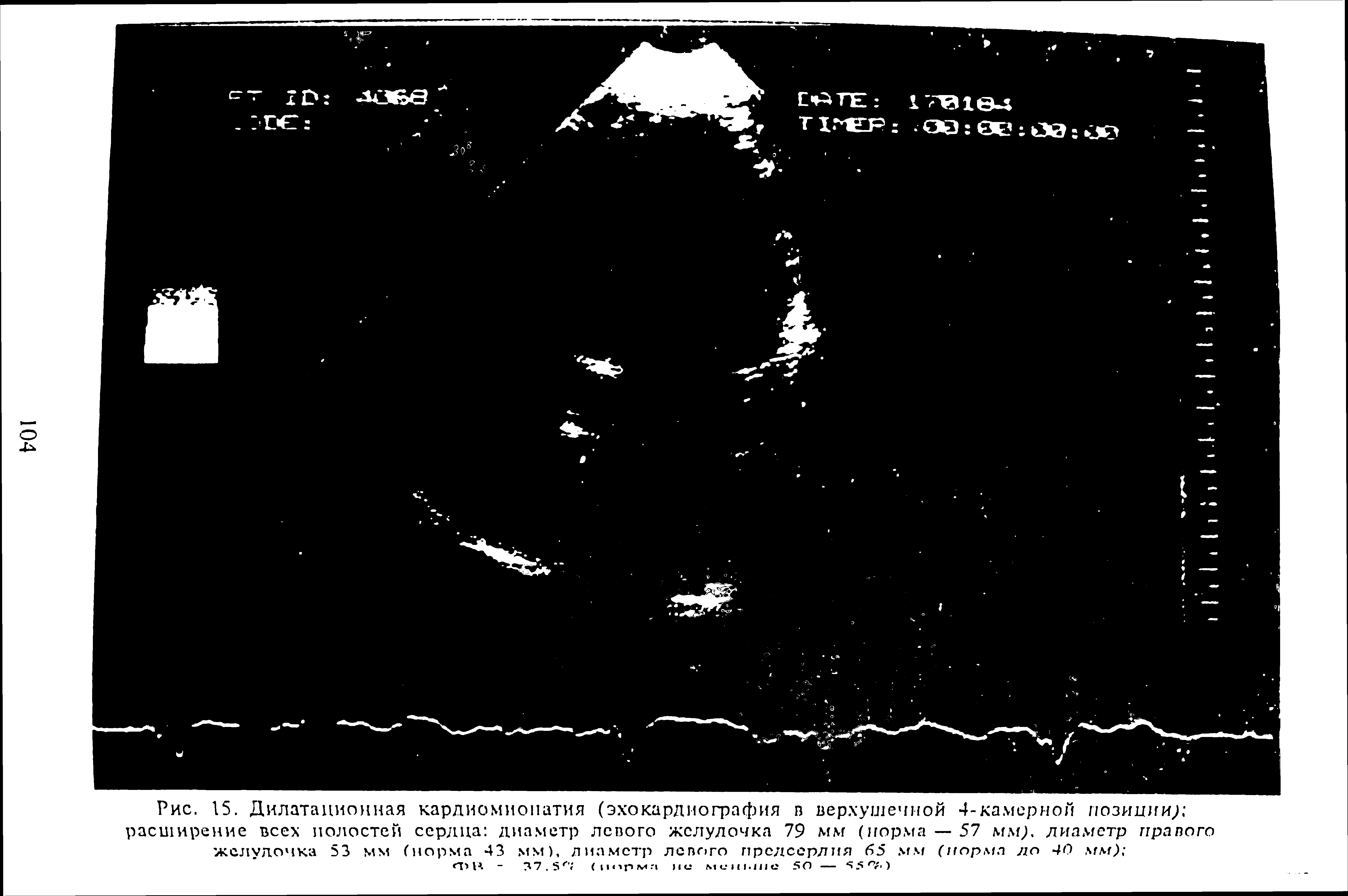 Рис. 15. Дилатационная кардиомиопатия (эхокардиография в верхушечной 4-камерной позиции расширение всех полостей сердца диаметр левого желудочка 79 мм (норма — 57 мм/ диаметр правого желудочка 53 мм (норма 43 мм), диаметр левого предсердия 65 мм (норма до 40 мм) ...