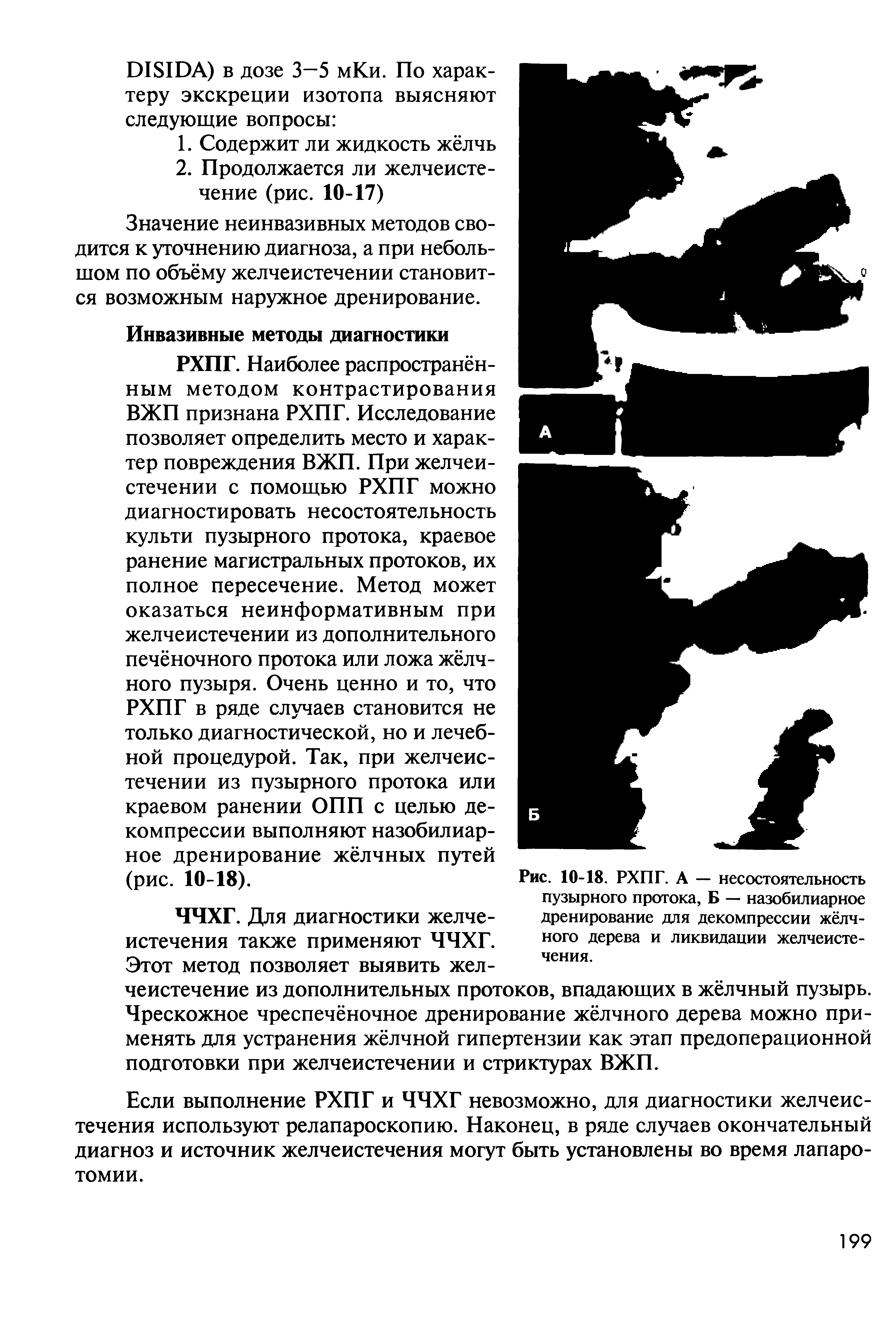 Рис. 10-18. РХПГ. А — несостоятельность пузырного протока, Б — назобилиарное дренирование для декомпрессии жёлчного дерева и ликвидации желчеисте-чения.