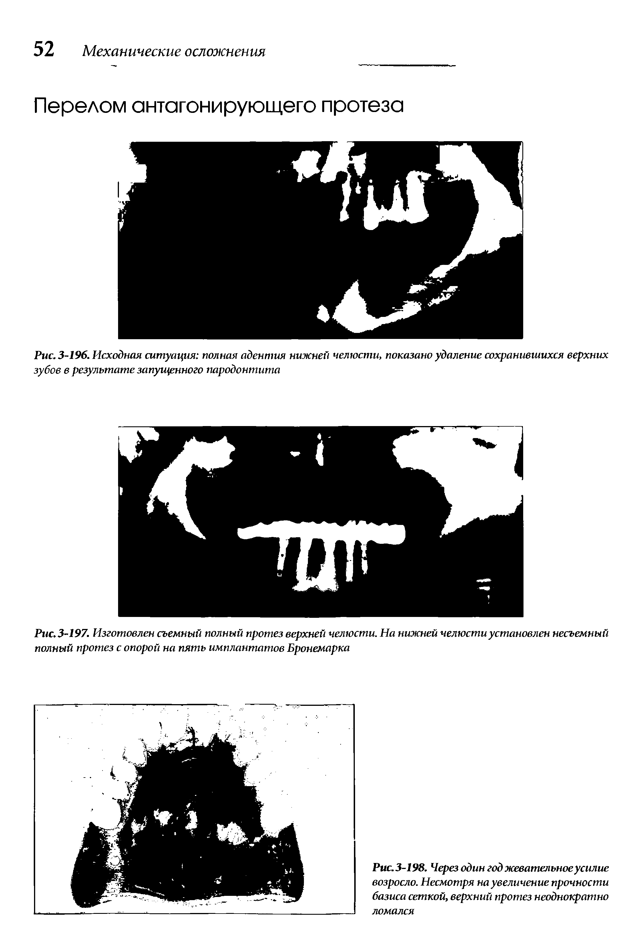 Рис. 3-197. Изготовлен съемный полный протез верхней челюсти. На нижней челюсти установлен несъемный полный протез с опорой на пять имплантатов Бронемарка...
