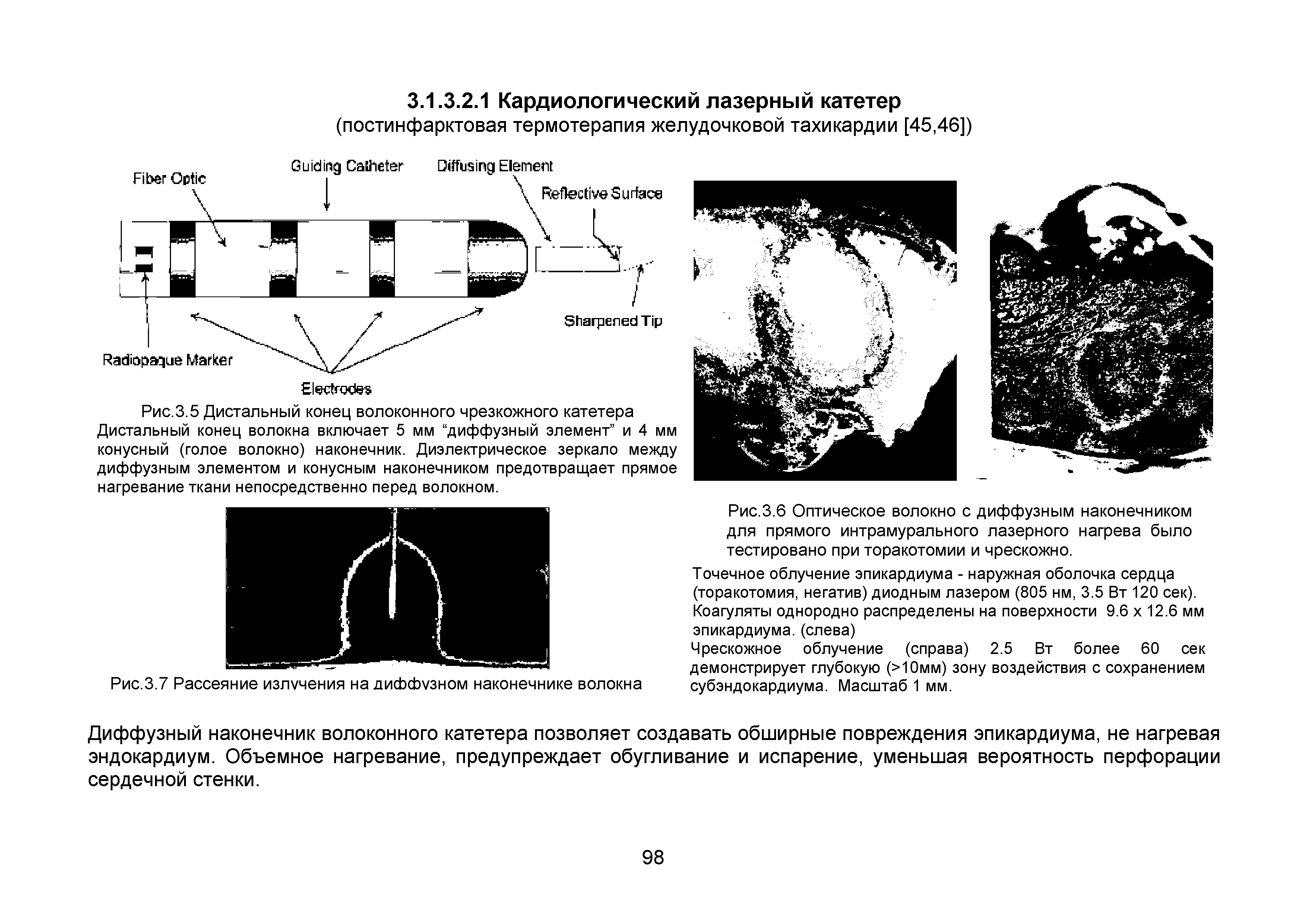 Рис.3.5 Дистальный конец волоконного чрезкожного катетера Дистальный конец волокна включает 5 мм диффузный элемент и 4 мм конусный (голое волокно) наконечник. Диэлектрическое зеркало между диффузным элементом и конусным наконечником предотвращает прямое нагревание ткани непосредственно перед волокном.