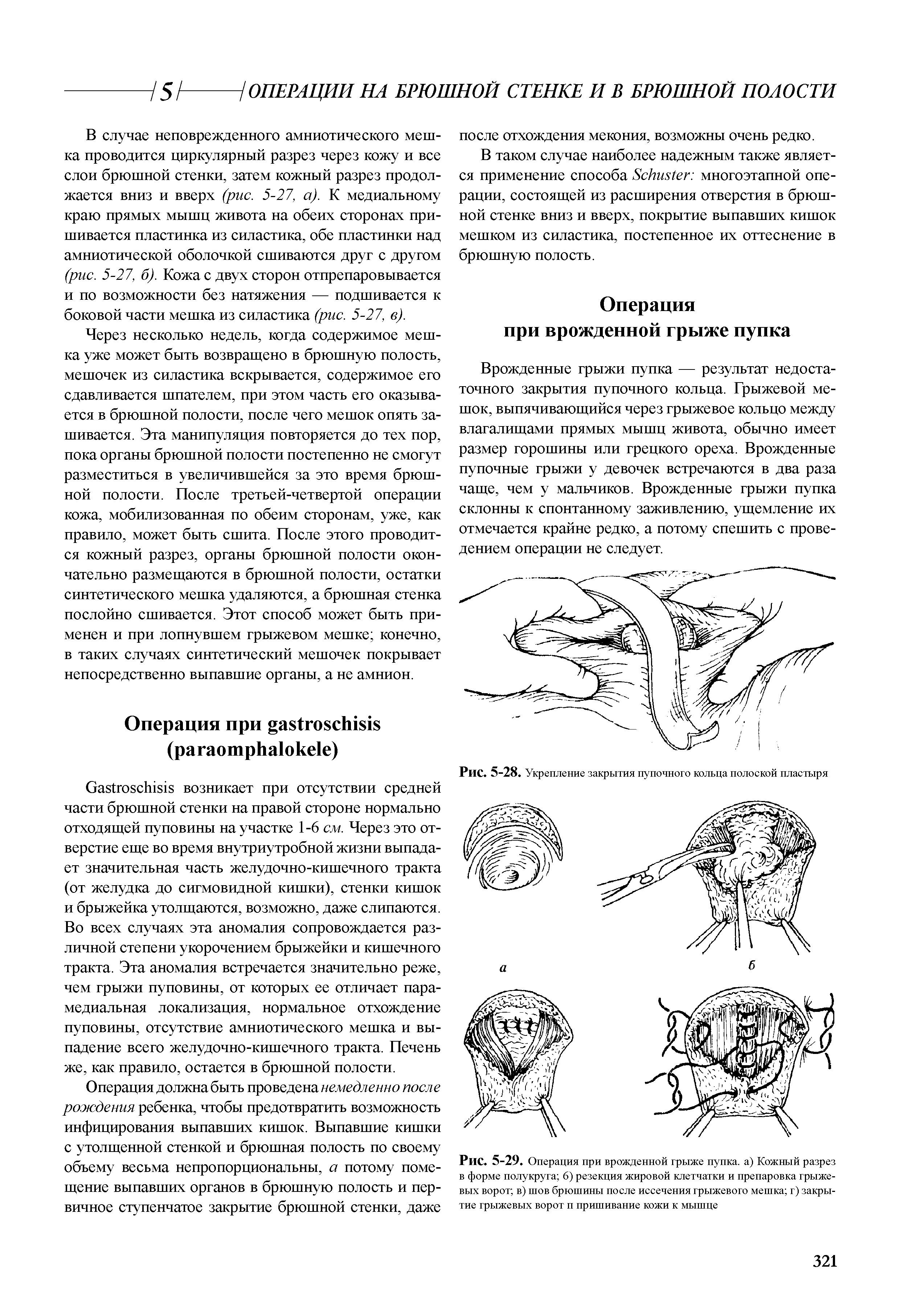 Рис. 5-29. Операция при врожденной грыже пупка, а) Кожный разрез в форме полукруга 6) резекция жировой клетчатки и препаровка грыжевых ворот в) шов брюшины после иссечения грыжевого мешка г) закрытие грыжевых ворот п пришивание кожи к мышце...