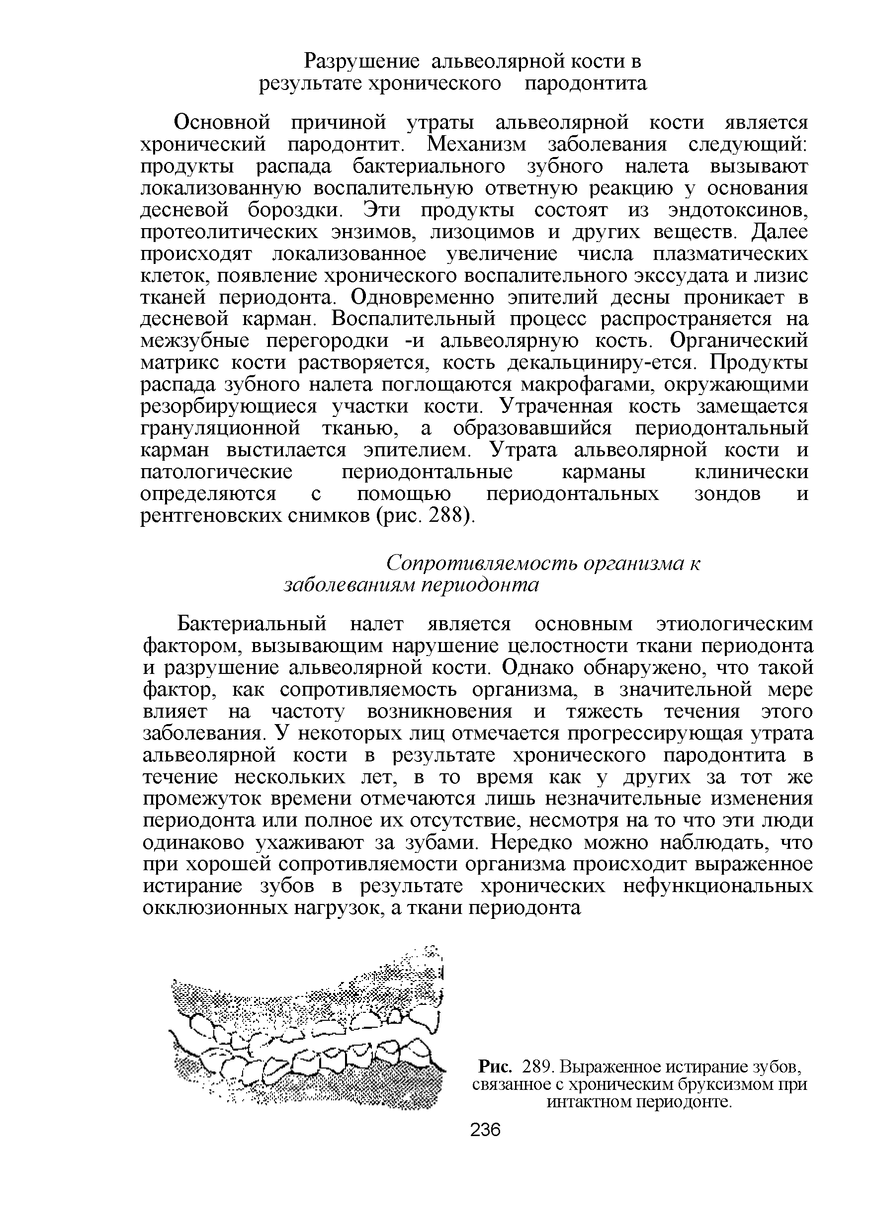 Рис. 289. Выраженное истирание зубов, связанное с хроническим бруксизмом при интактном периодонте.