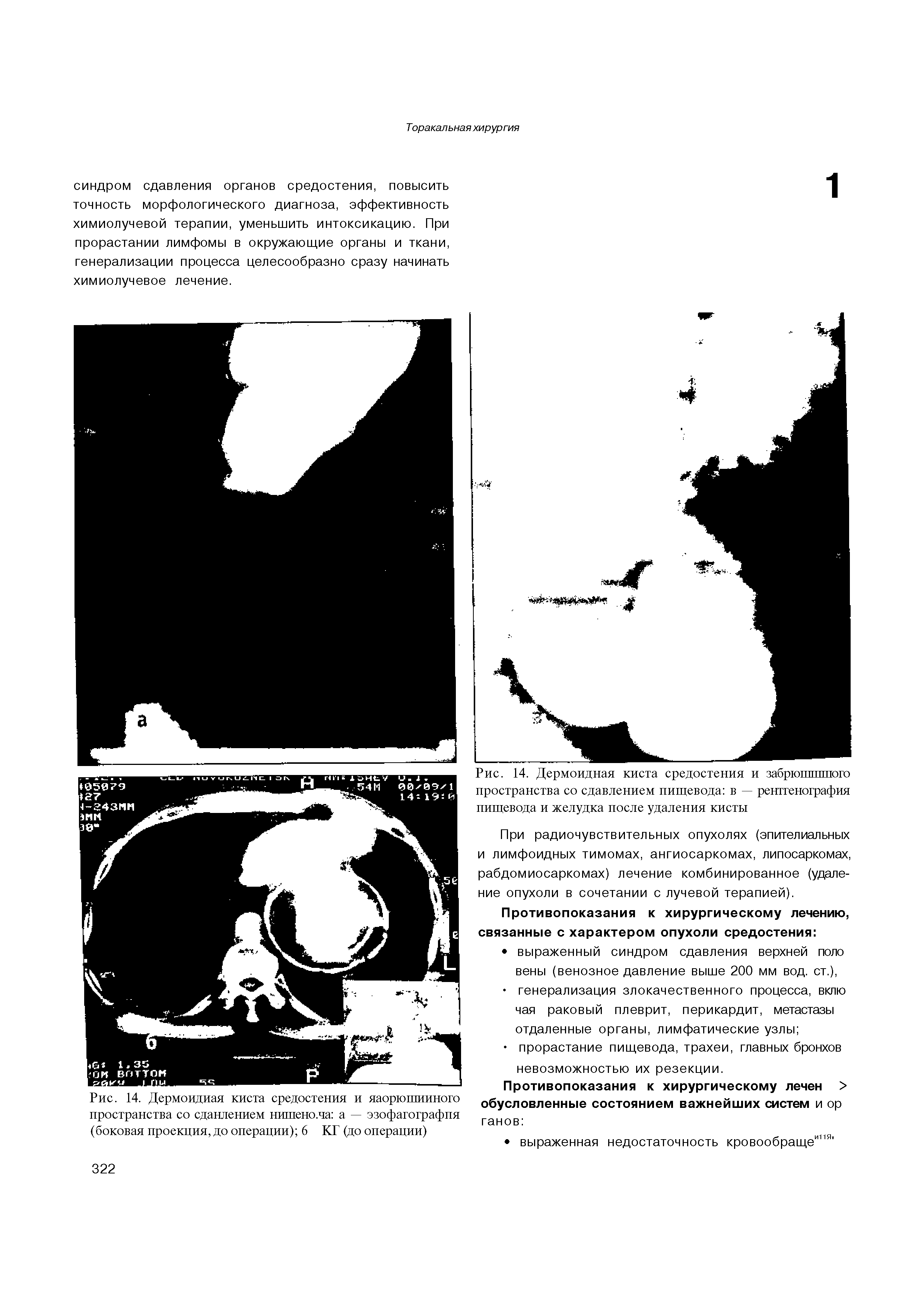 Рис. 14. Дермоидная киста средостения и яаорюшинного пространства со сданлением нишено.ча а — эзофагографпя (боковая проекция, до операции) 6 КГ (до операции)...