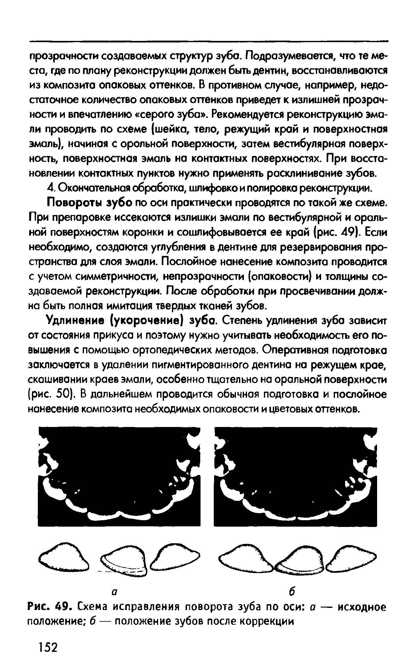 Рис. 49. Схема исправления поворота зуба по оси о — исходное положение б — положение зубов после коррекции...