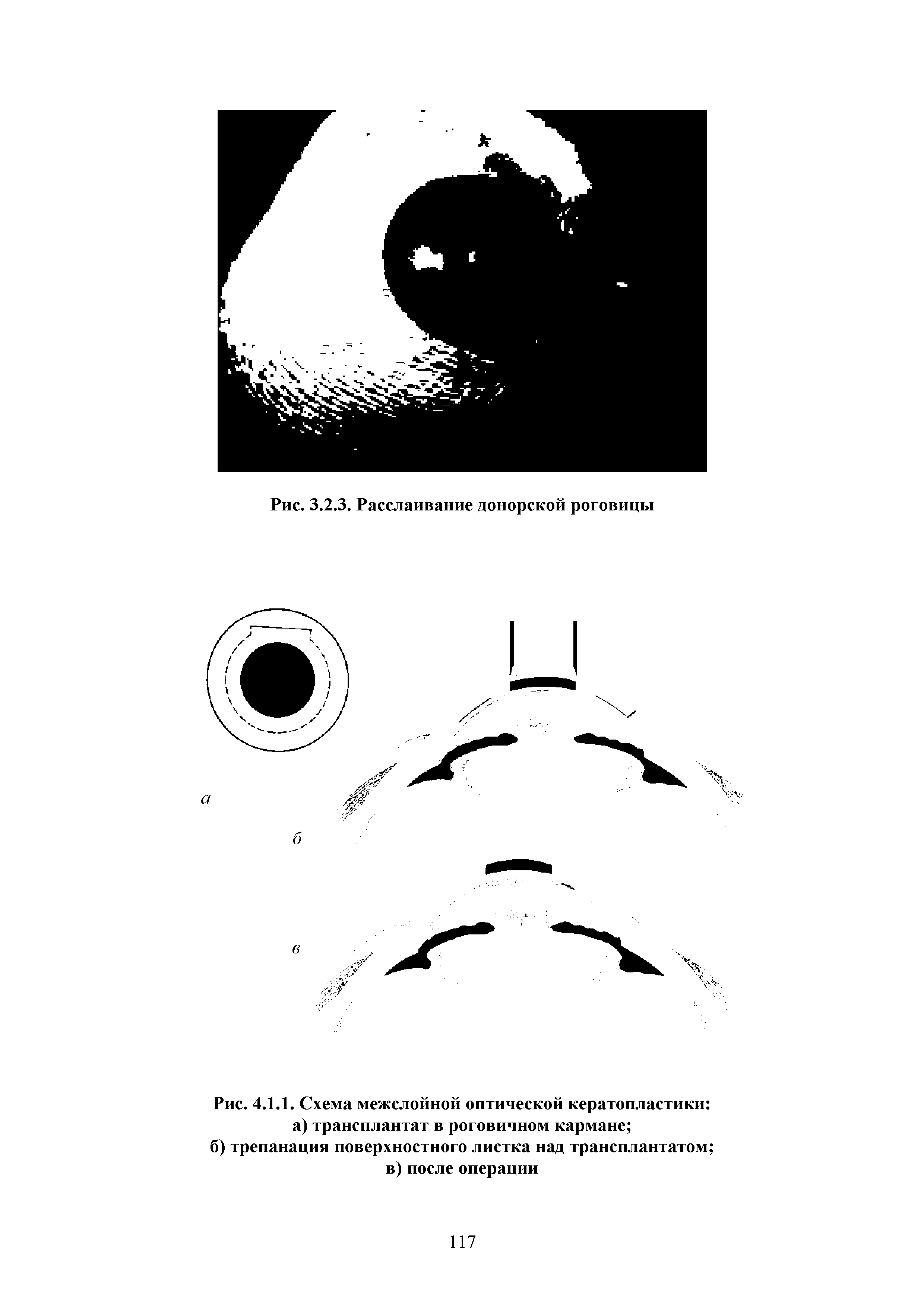 Рис. 4.1.1. Схема межслойной оптической кератопластики а) трансплантат в роговичном кармане ...