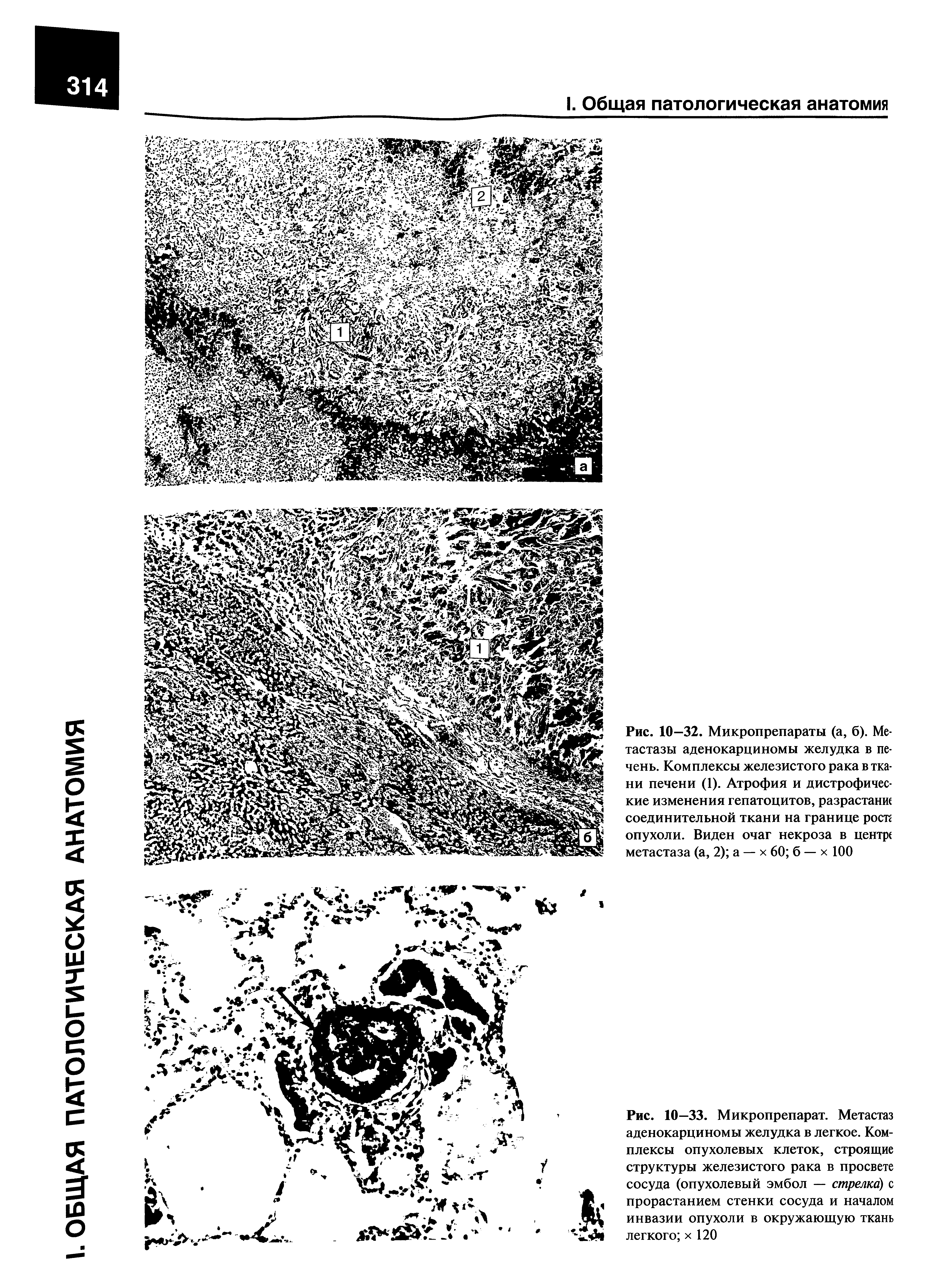 Рис. 10—32. Микропрепараты (а, б). Метастазы аденокарциномы желудка в печень. Комплексы железистого рака в ткани печени (1). Атрофия и дистрофические изменения гепатоцитов, разрастание соединительной ткани на границе рост( опухоли. Виден очаг некроза в центре метастаза (а, 2) а — х 60 б — х 100...