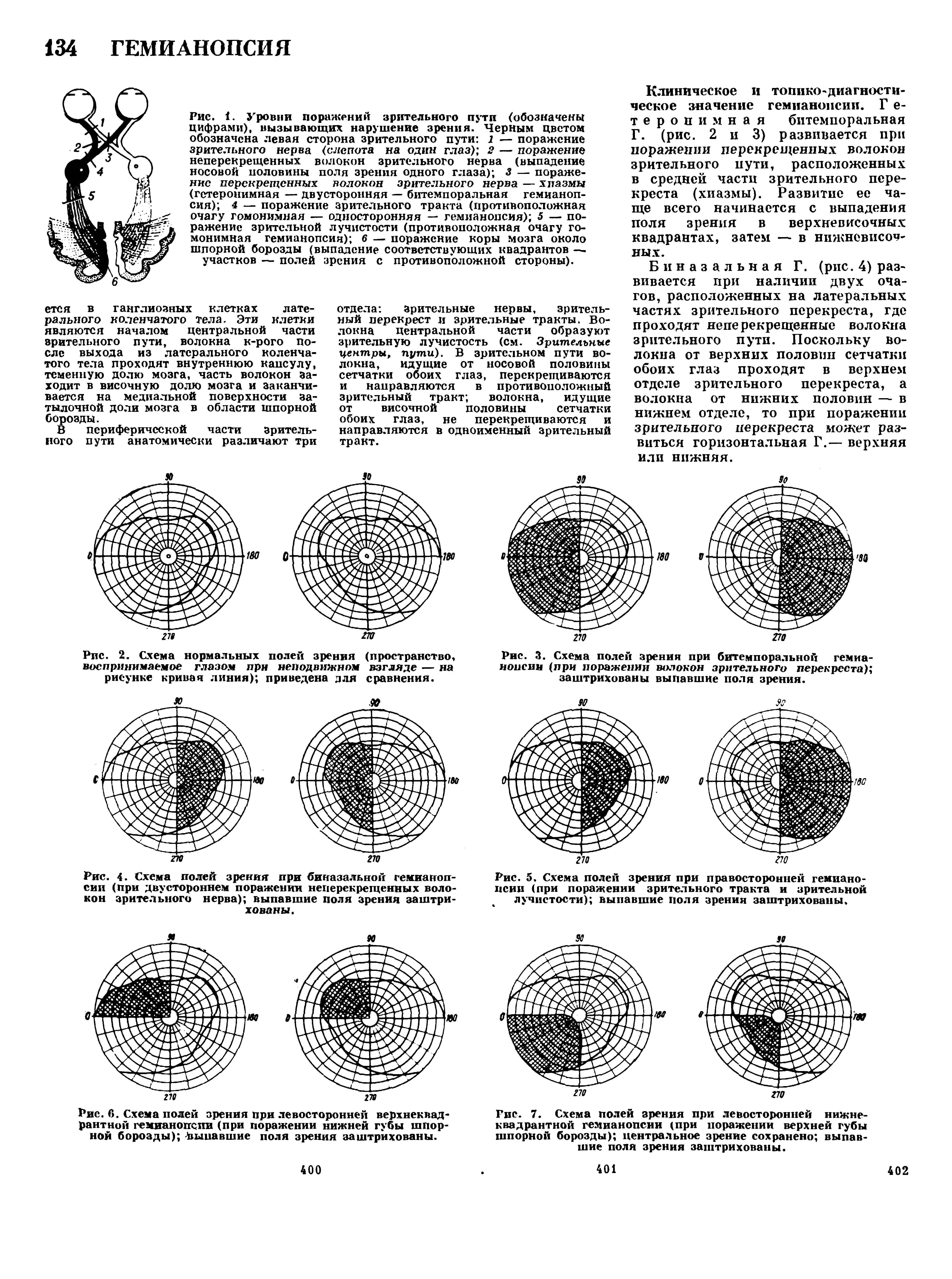 Поля зрения в норме. Выпадение полей зрения гемианопсии. Схема выпадения полей зрения. Гомонимная гемианопсия – это выпадение полей зрения. Поля зрения перекрёст схема.