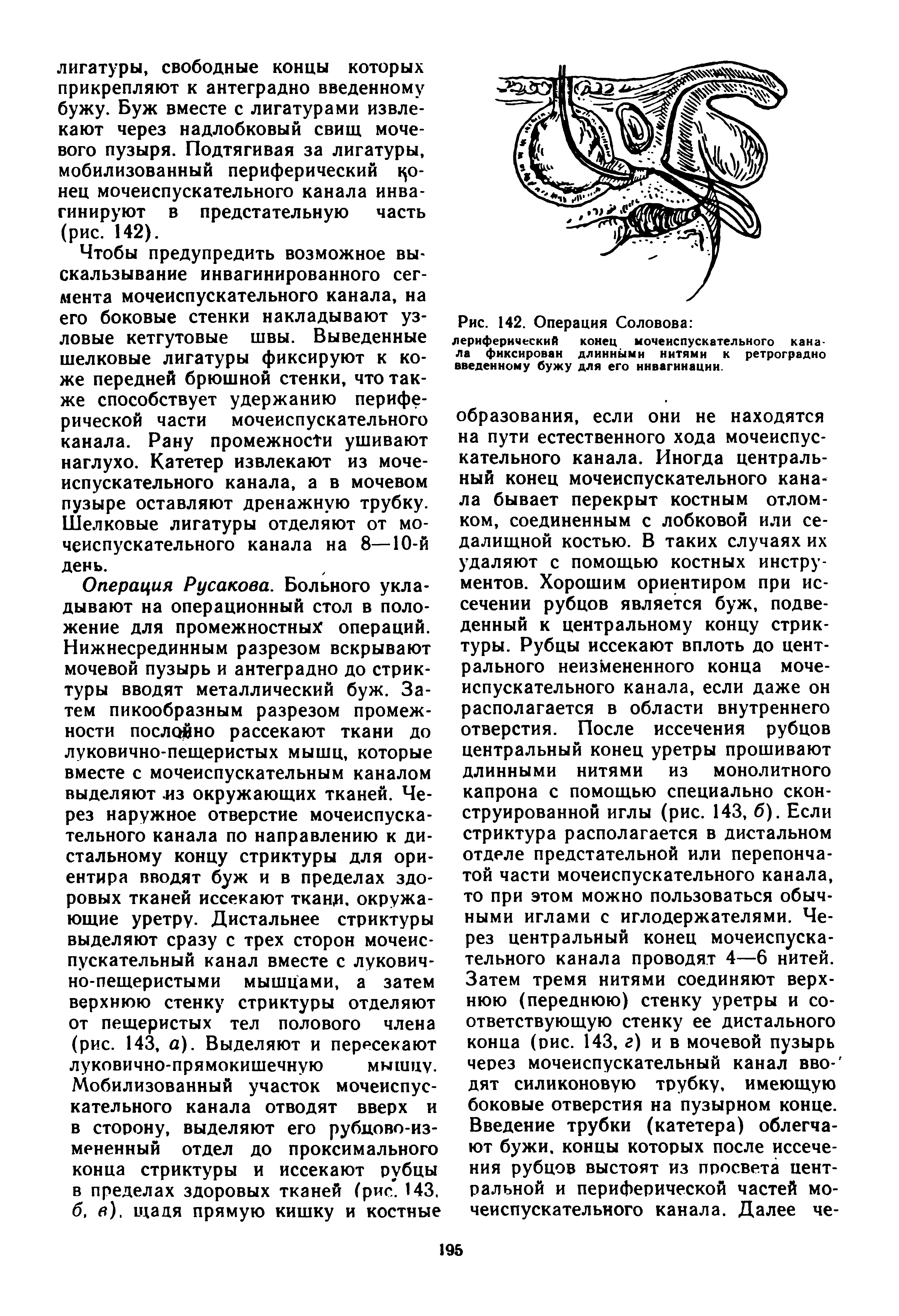 Рис. 142. Операция Соловова периферический конец мочеиспускательного канала фиксирован длинными нитями к ретроградно введенному бужу для его инвагинации.