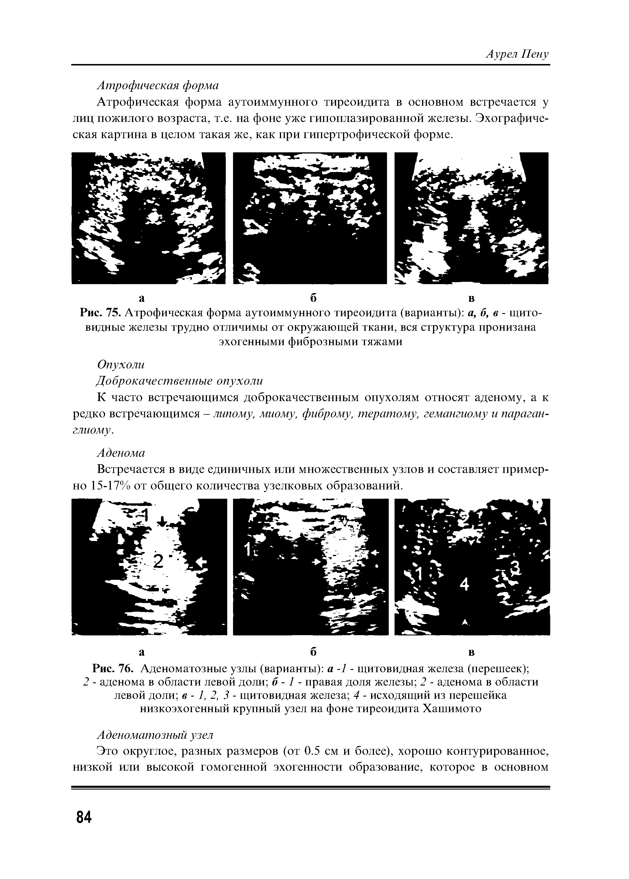 Рис. 76. Аденоматозные узлы (варианты) а -1 - щитовидная железа (перешеек) ...