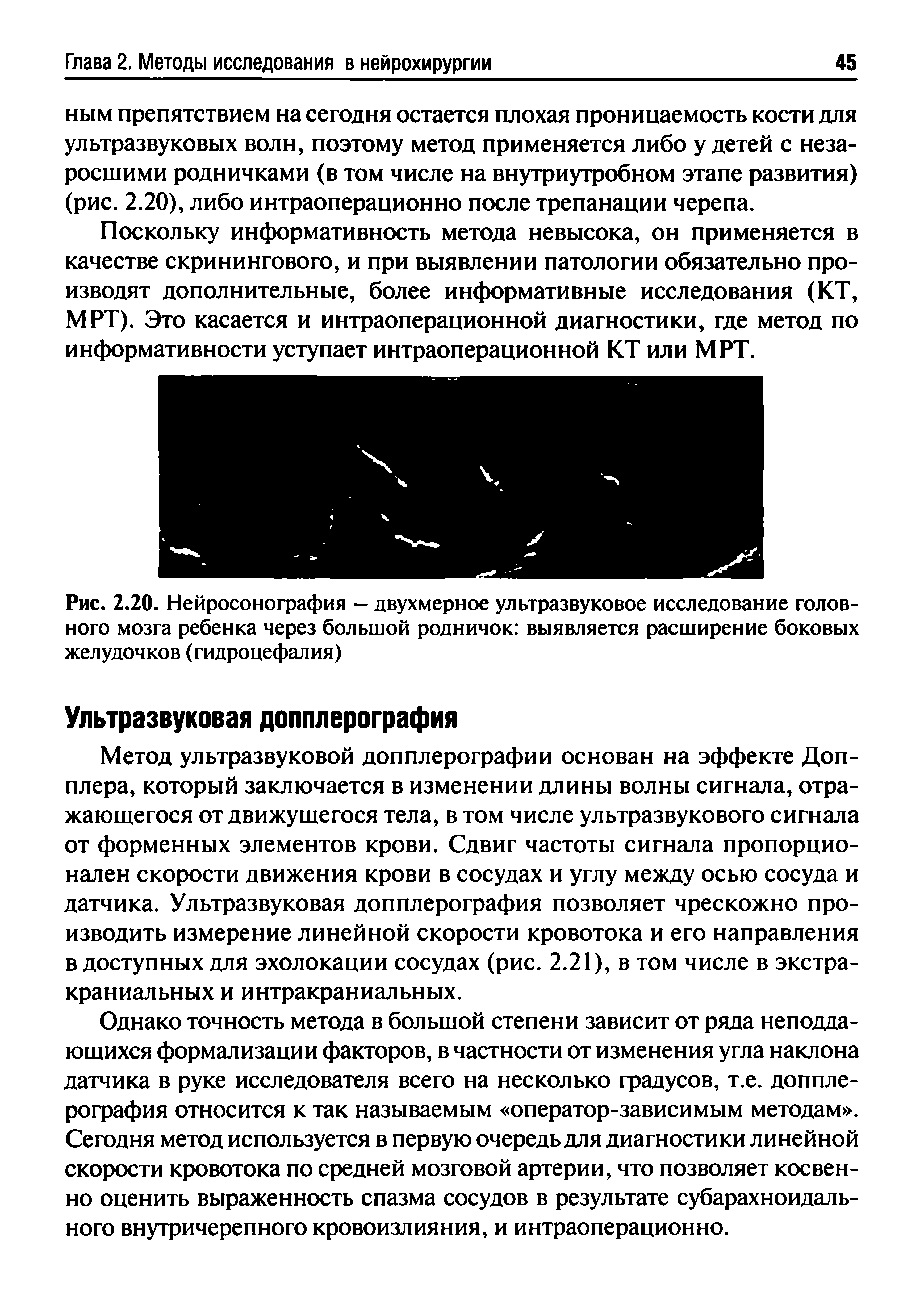 Рис. 2.20. Нейросонография — двухмерное ультразвуковое исследование головного мозга ребенка через большой родничок выявляется расширение боковых желудочков (гидроцефалия)...