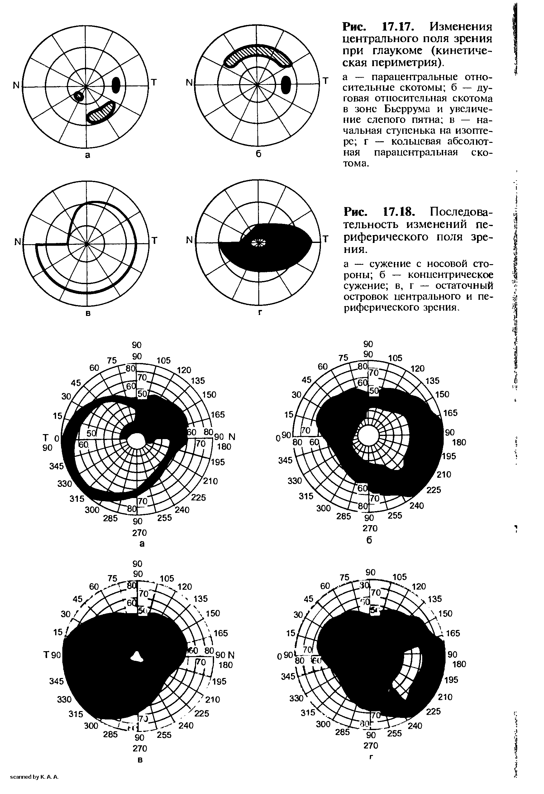 Рис. 17.17. Изменения центрального поля зрения при глаукоме (кинетическая периметрия).