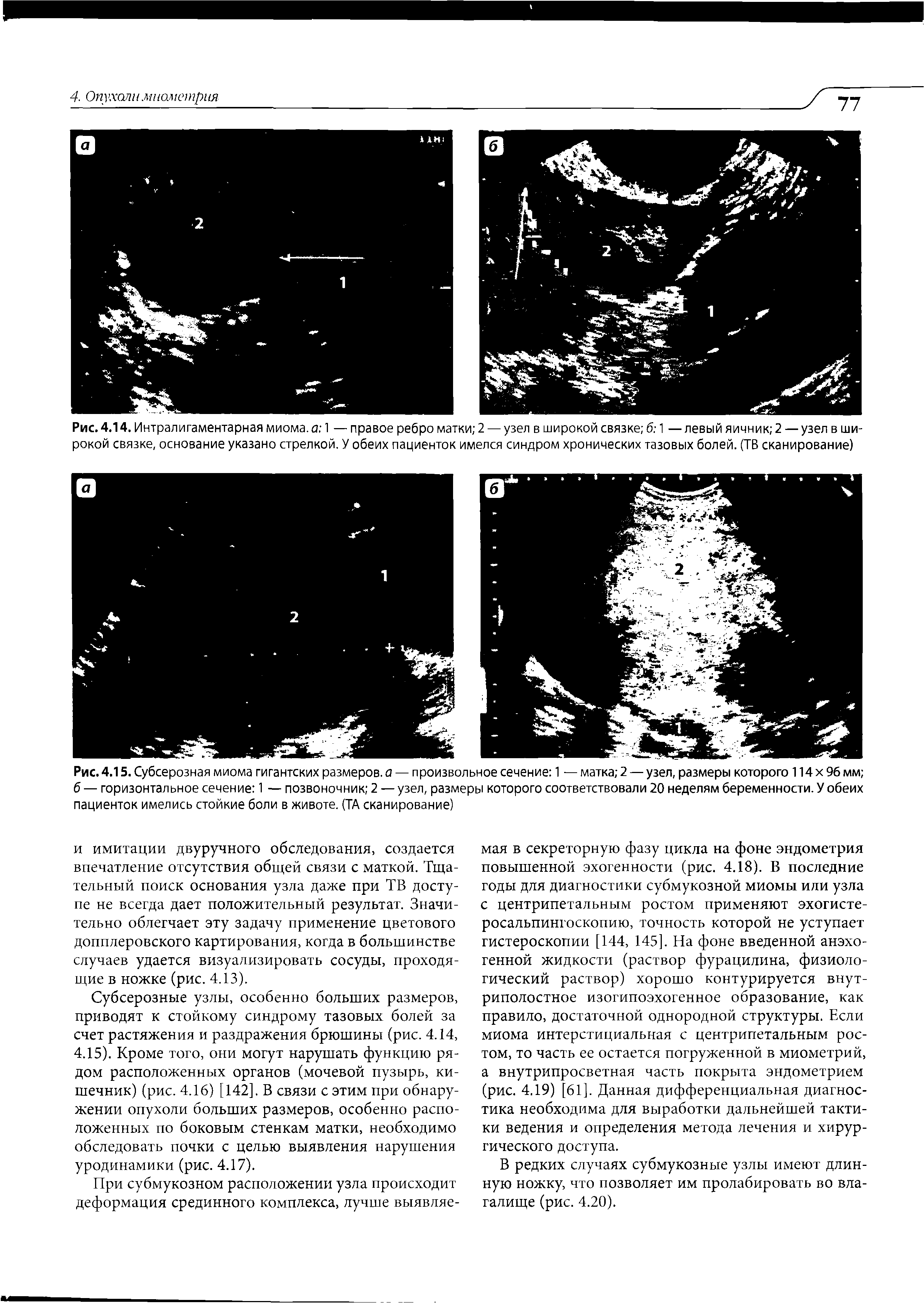 Рис. 4.14. Интралигаментарная миома, а 1 — правое ребро матки 2 — узел в широкой связке б 1 —левый яичник 2 — узел в широкой связке, основание указано стрелкой. У обеих пациенток имелся синдром хронических тазовых болей. (ТВ сканирование)...