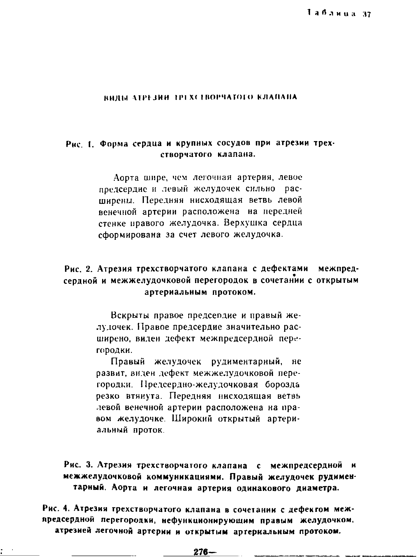 Рис. I. Форма сердца и крупных сосудов при атрезии трехстворчатого клапана.