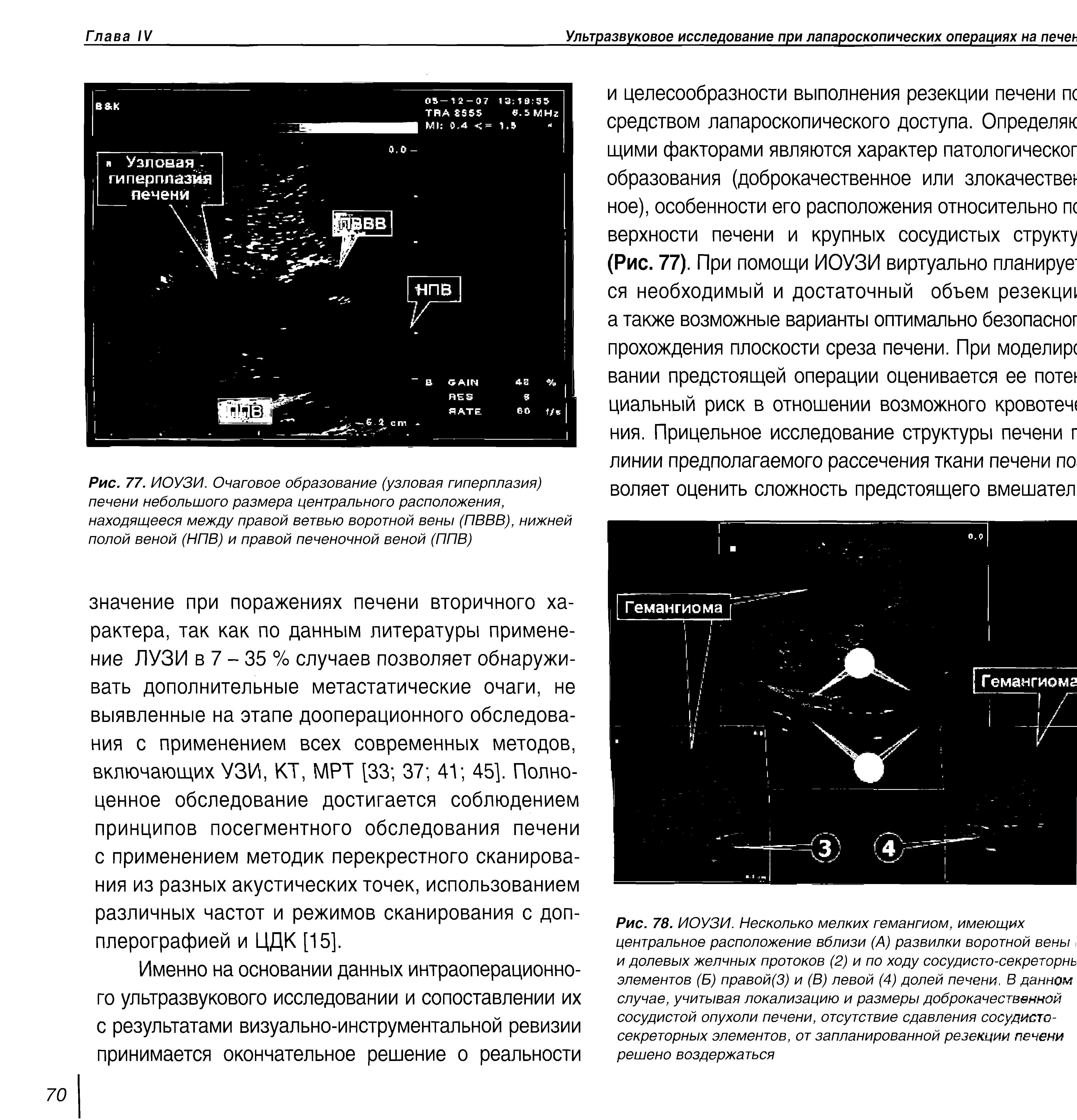 Рис. 77. ИОУЗИ. Очаговое образование (узловая гиперплазия) печени небольшого размера центрального расположения, находящееся между правой ветвью воротной вены (ПВВВ), нижней полой веной (НПВ) и правой печеночной веной (ППВ)...