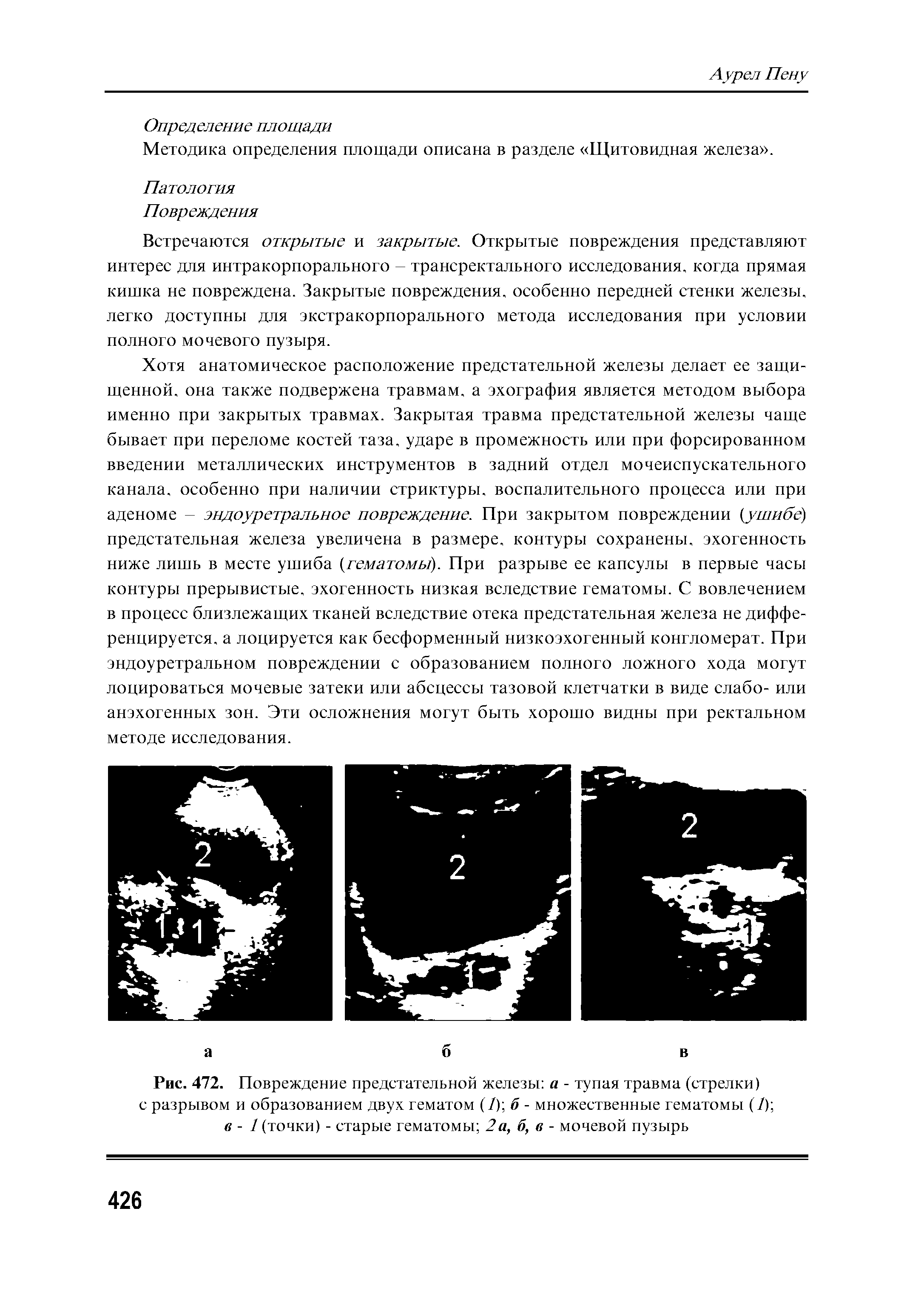 Рис. 472. Повреждение предстательной железы а - тупая травма (стрелки) с разрывом и образованием двух гематом (/) б - множественные гематомы (/) в - / (точки) - старые гематомы 2а, б, в - мочевой пузырь...