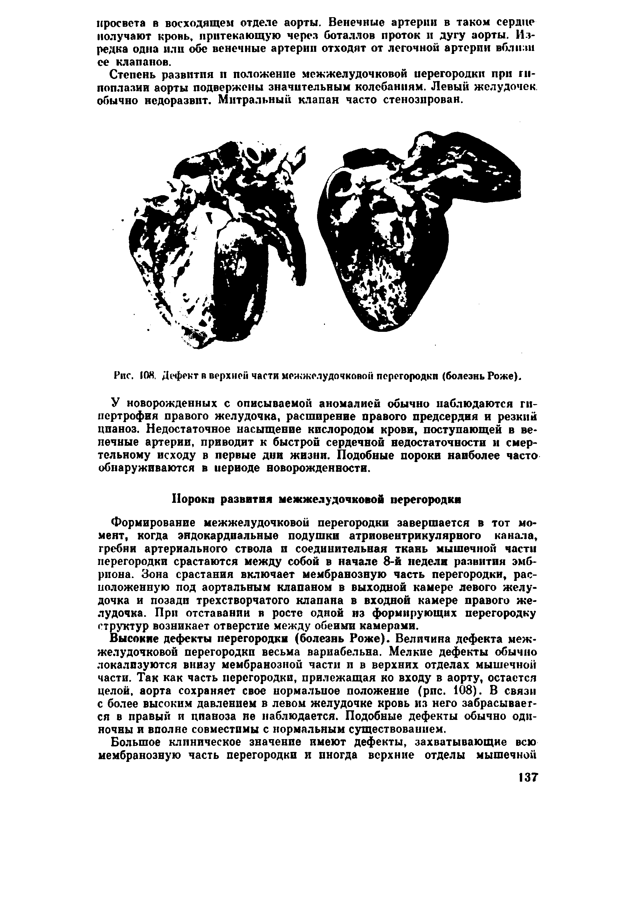 Рис. 10Я. Дефект в верхней части межжелудочковой перегородки (болезнь Роже).