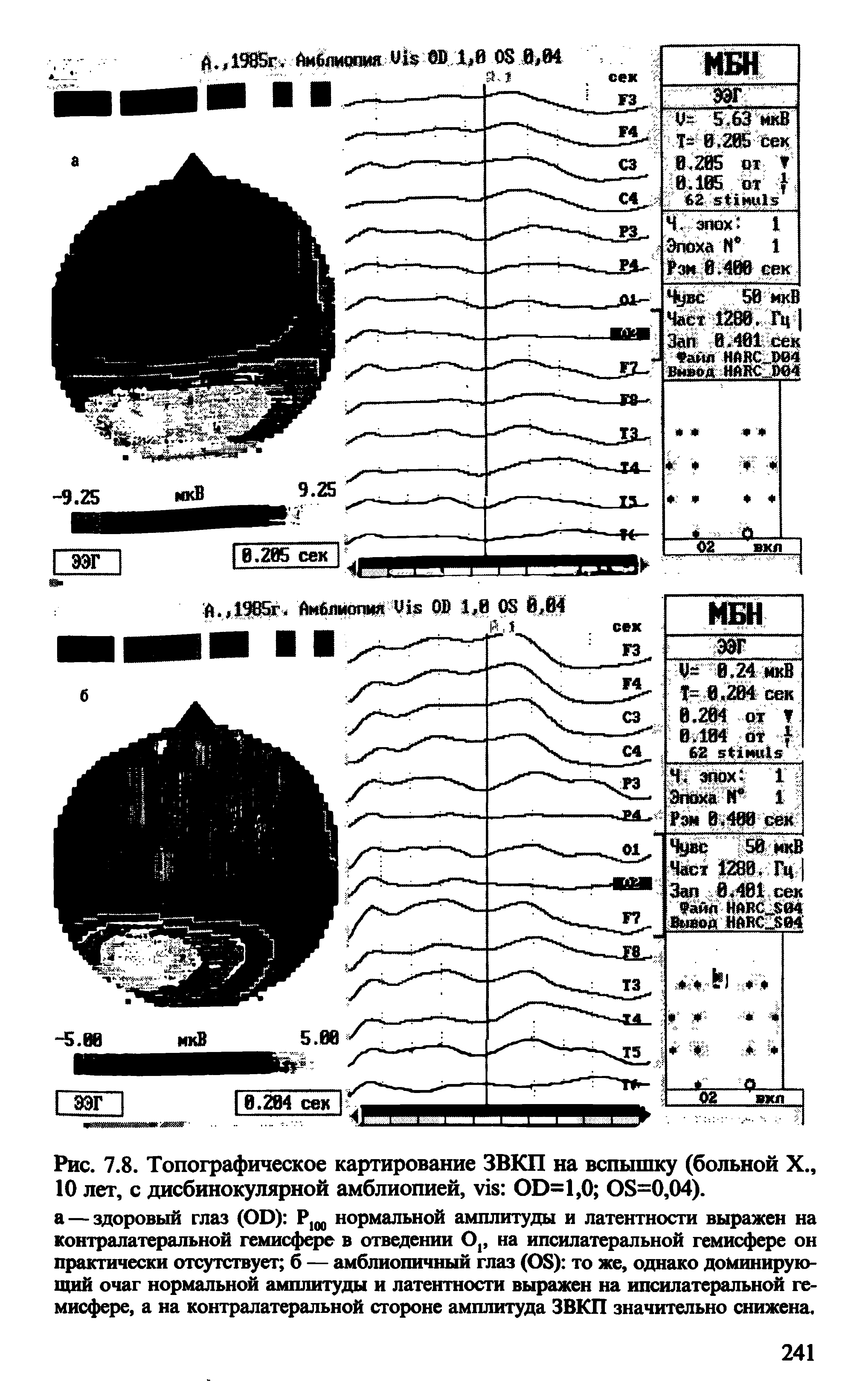 Рис. 7.8. Топографическое картирование ЗВКП на вспышку (больной X., 10 лет, с дисбинокулярной амблиопией, OD=1,0 OS=0,04).