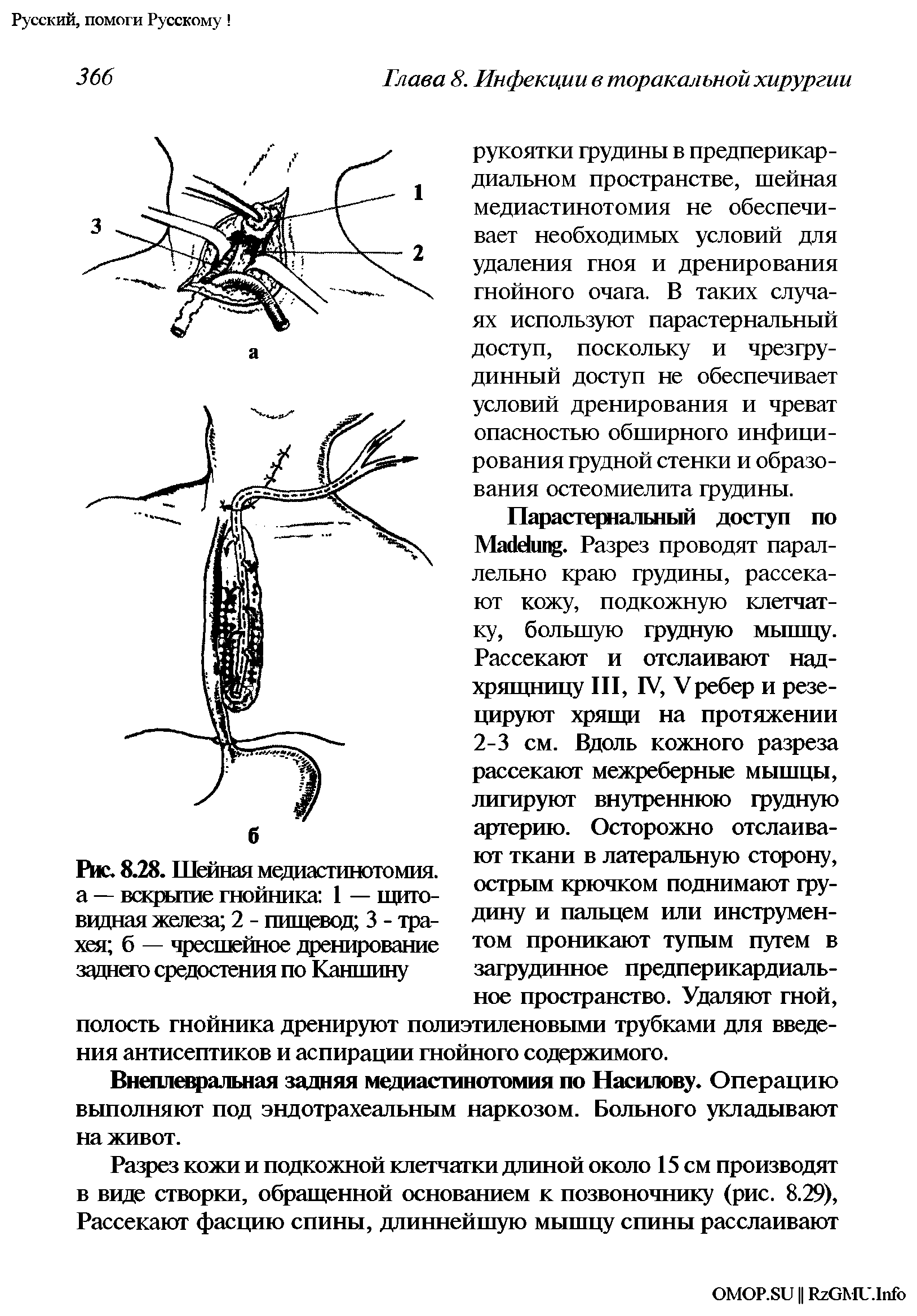 Рис. 8.28. Шейная медиастинотомия. а — вскрытие гнойника 1 — щитовидная железа 2 - пищевод 3 - трахея б — чресшейное дренирование заднего средостения по Каншину...