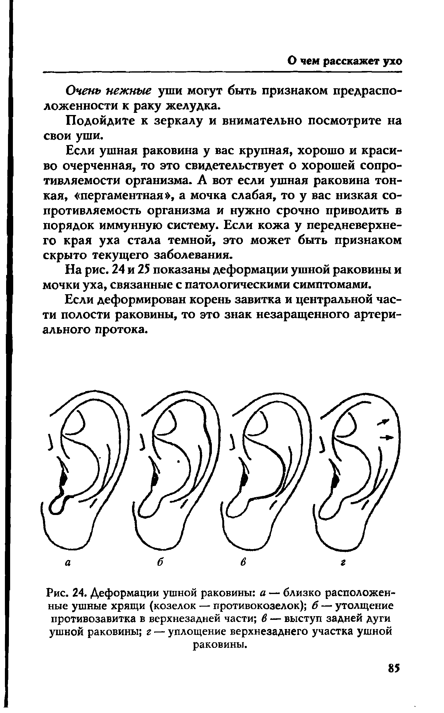 Рис. 24. Деформации ушной раковины а — близко расположенные ушные хрящи (козелок — противокозелок) б — утолщение противозавитка в верхнезадней части в — выступ задней дуги ушной раковины г — уплощение верхнезаднего участка ушной раковины.