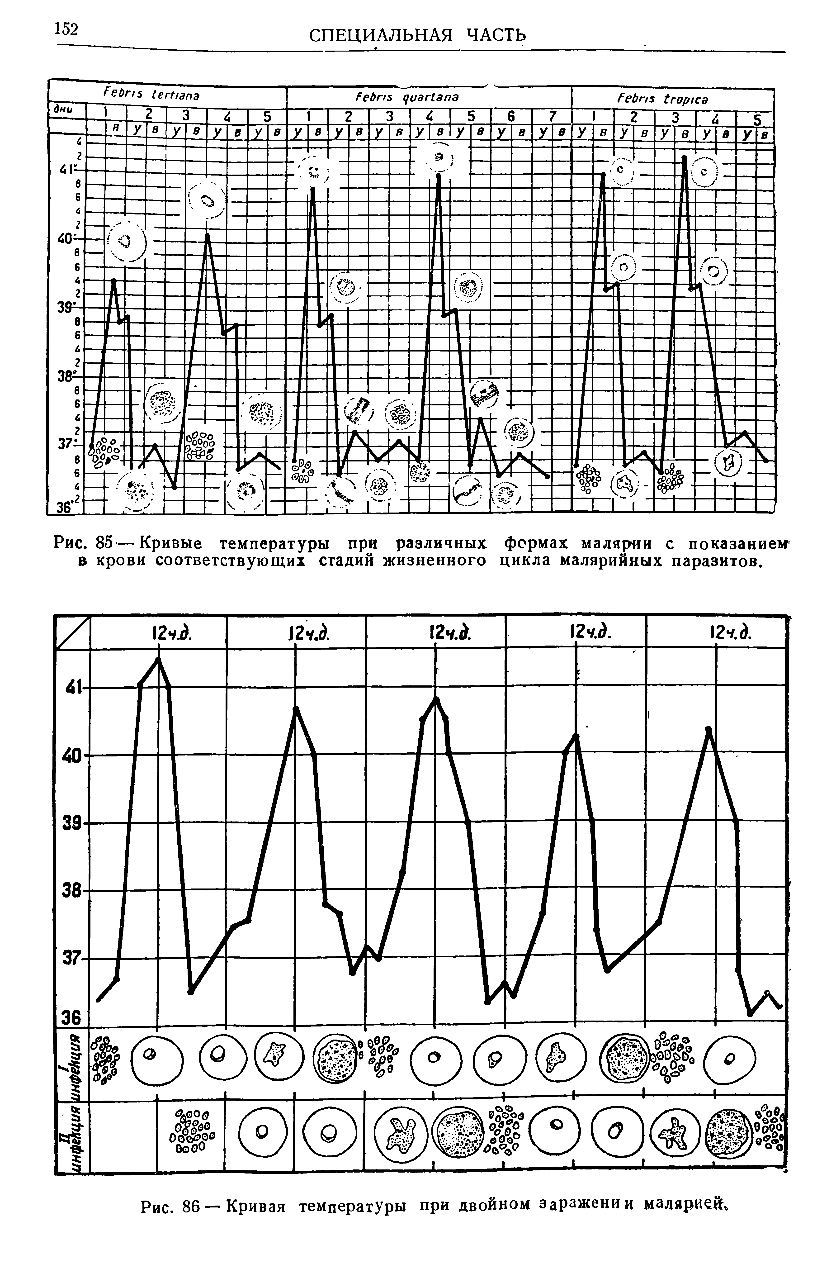 Рис. 85—Кривые температуры при различных формах малярии с показанием в крови соответствующих стадий жизненного цикла малярийных паразитов.