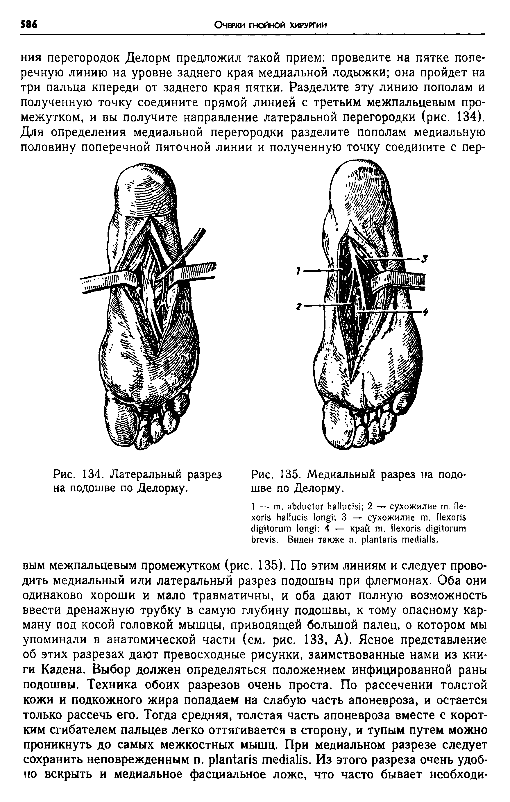 Рис. 134. Латеральный разрез Рис. 135. Медиальный разрез на подо-на подошве по Делорму. шве по Делорму.