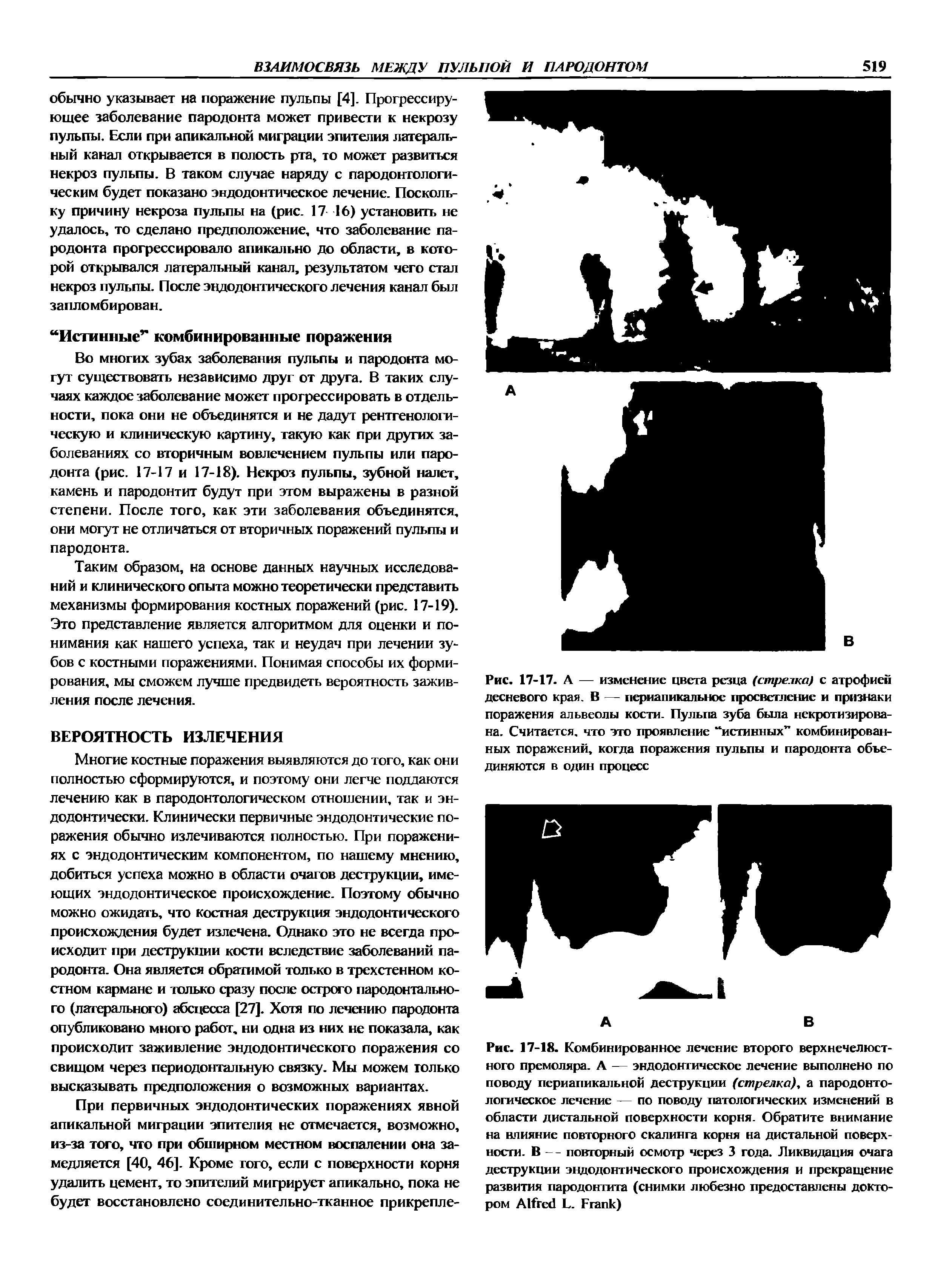 Рис. 17-17. А — изменение цвета резца (стрелка) с атрофией десневого края. В — периапикальное просветление и признаки поражения альвеолы кости. Пульпа зуба была некротизирована. Считается, что это проявление истинных комбинированных поражений, когда поражения пульпы и пародонта объединяются в один процесс...