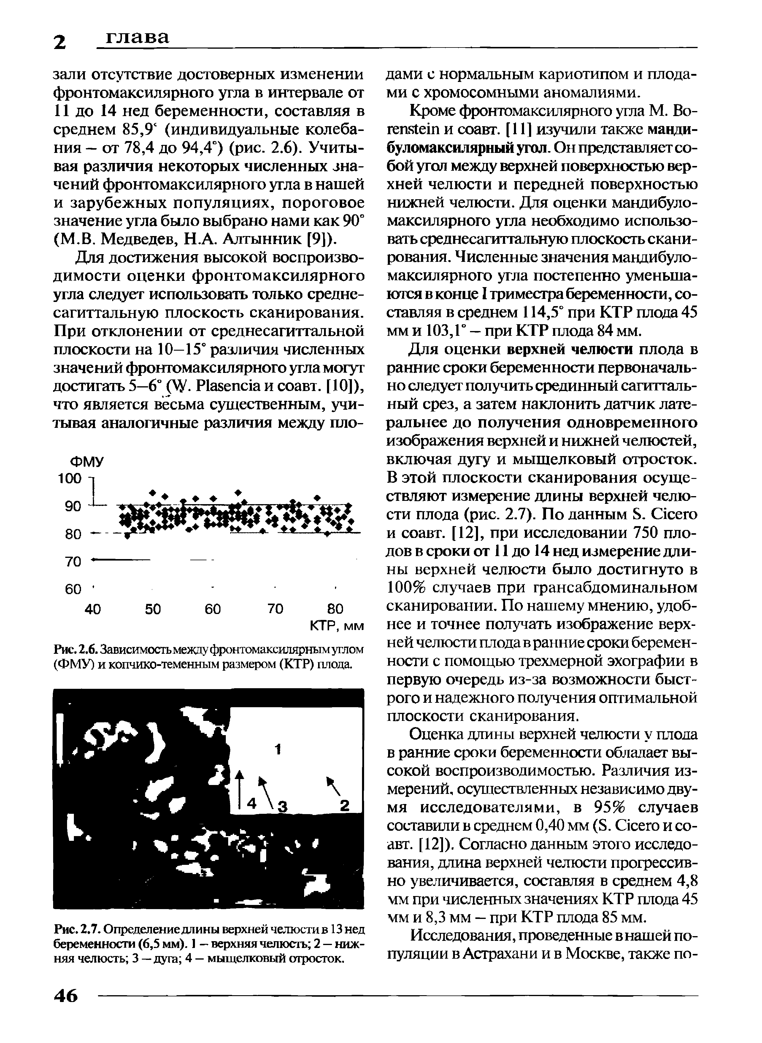 Рис. 2.7. Определение длины верхней челюсти в 13 нед беременности (6,5 мм). 1 — верхняя челюсть 2 — нижняя челюсть 3 — дуга 4 — мыщелковый отросток.