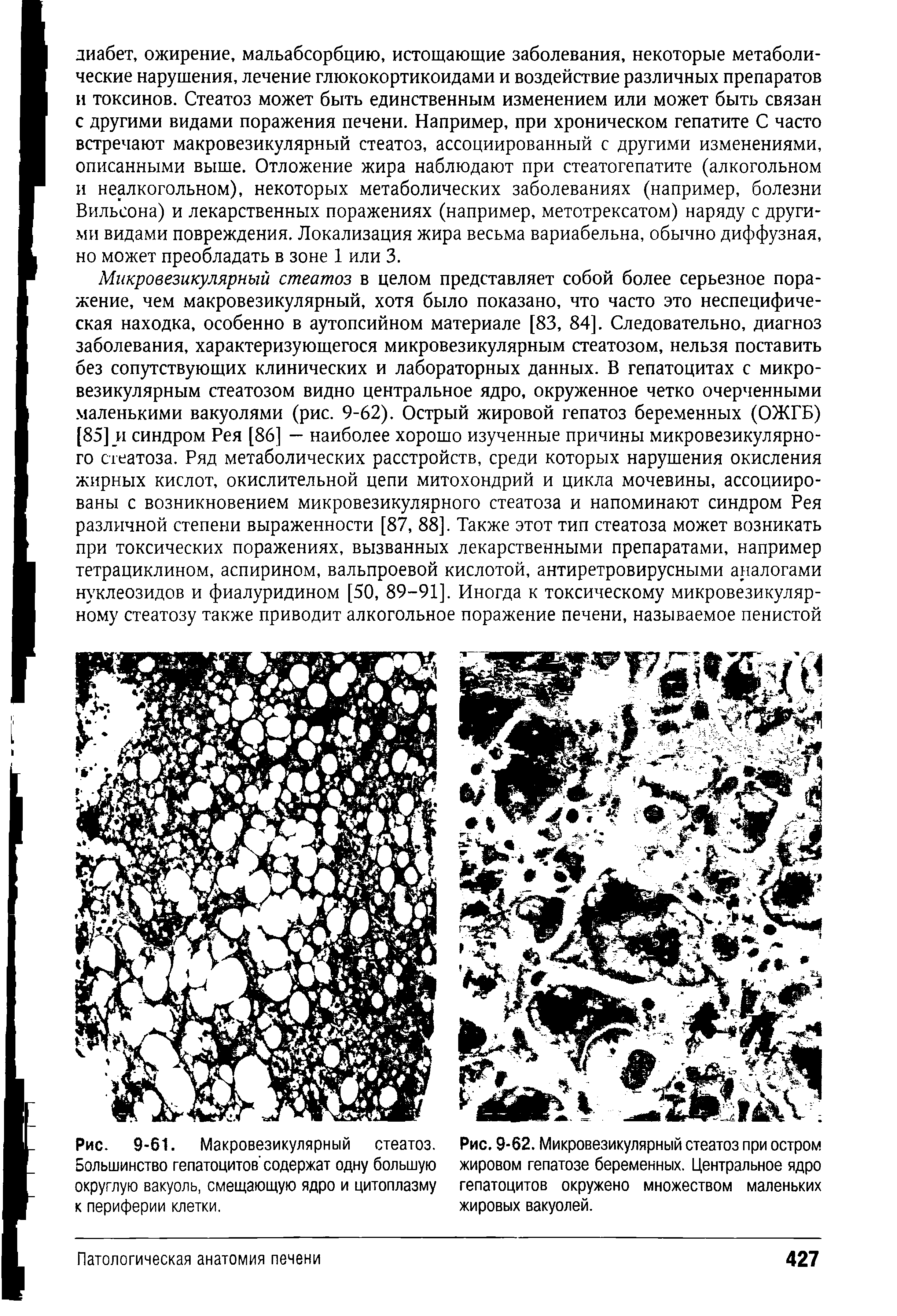 Рис. 9-62. Микровезикулярный стеатоз при остром жировом гепатозе беременных. Центральное ядро гепатоцитов окружено множеством маленьких жировых вакуолей.