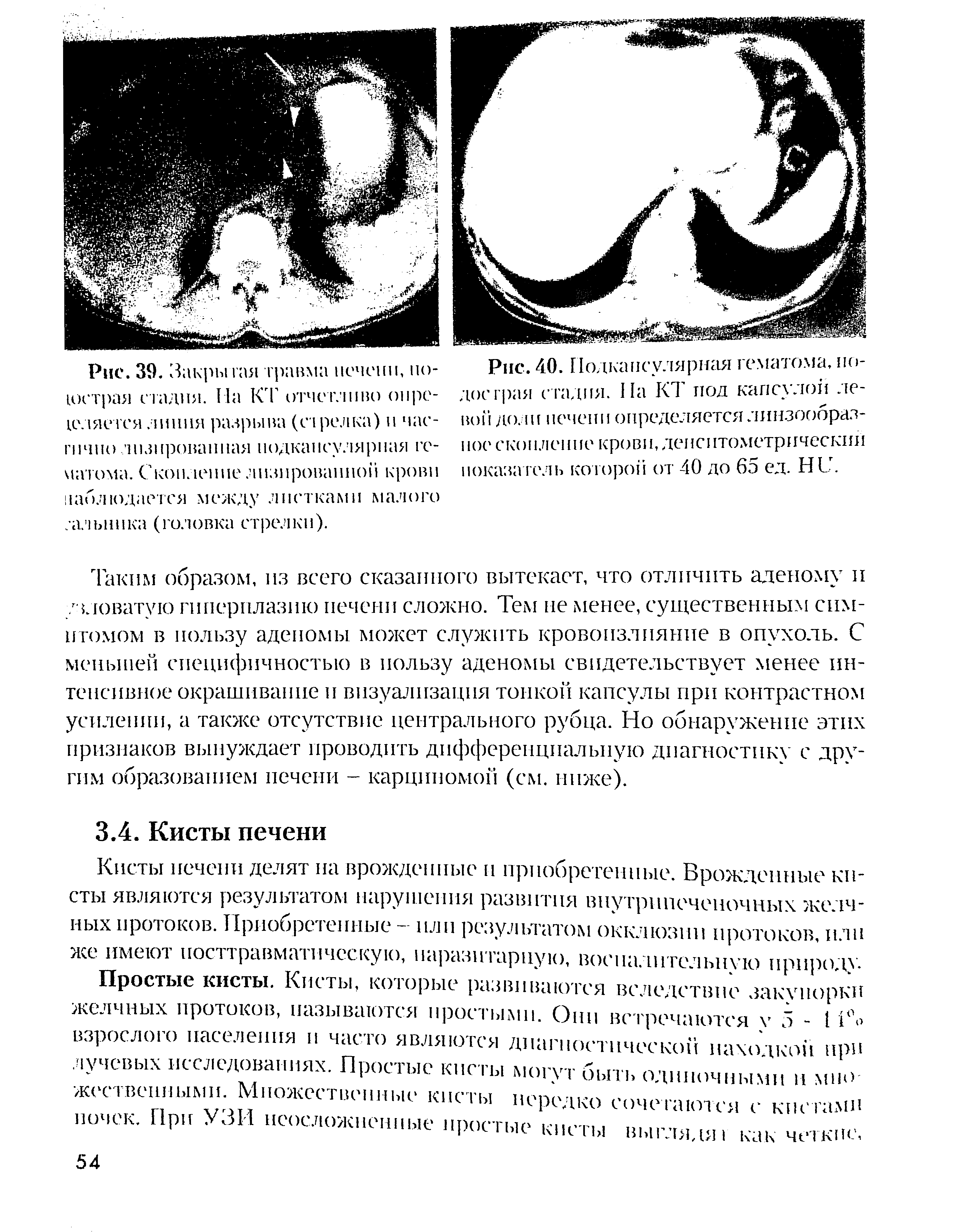 Рис. 40. Нодкансулярпая гематома, подострая стадия. 11а К1 под капсулой левой доли печени определяется линзообразное скопление крови, деисптомстрическии показатель которой от 40 до 65 ед. НС.