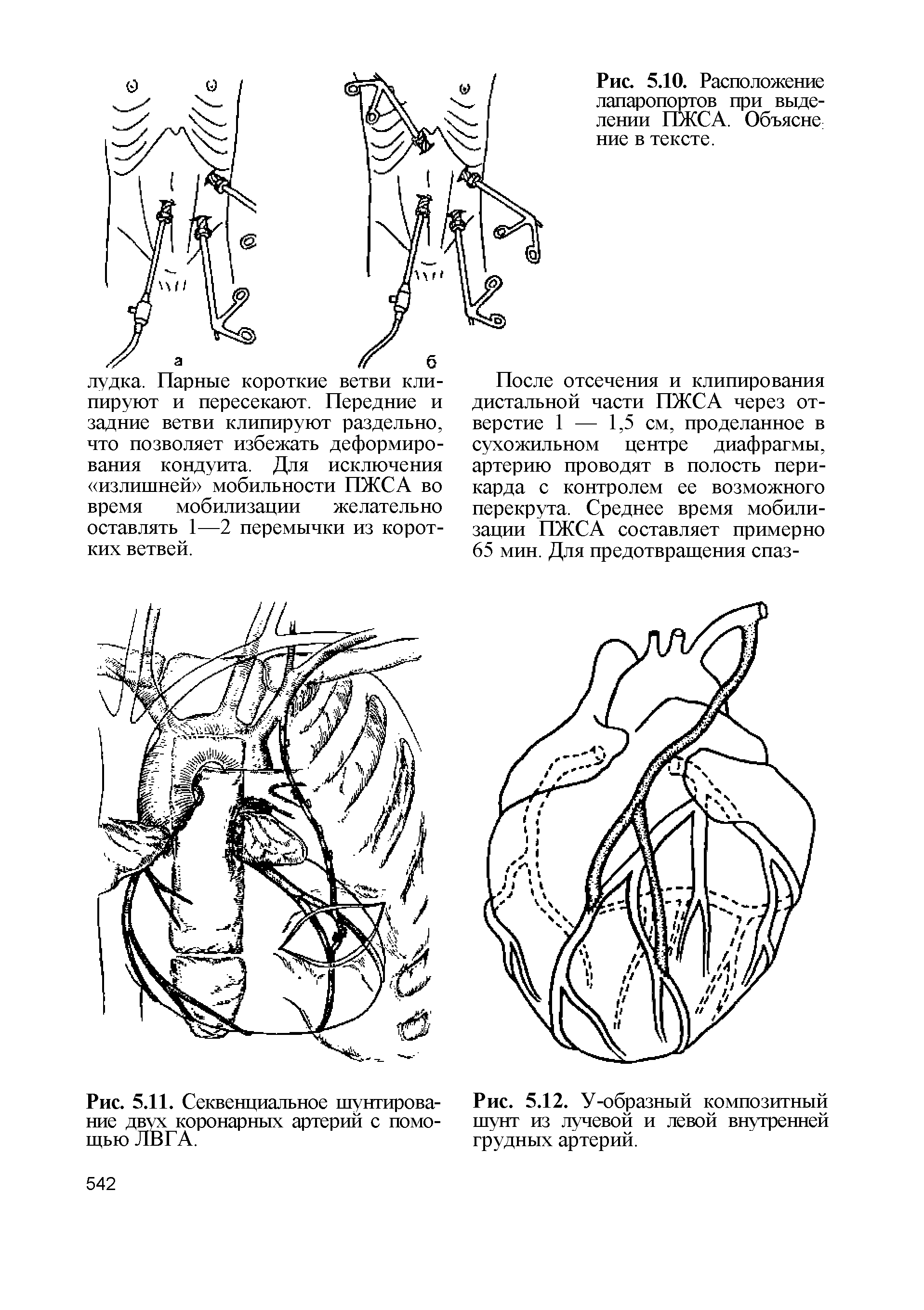 Рис. 5.12. У-образный композитный шунт из лучевой и левой внутренней грудных артерий.