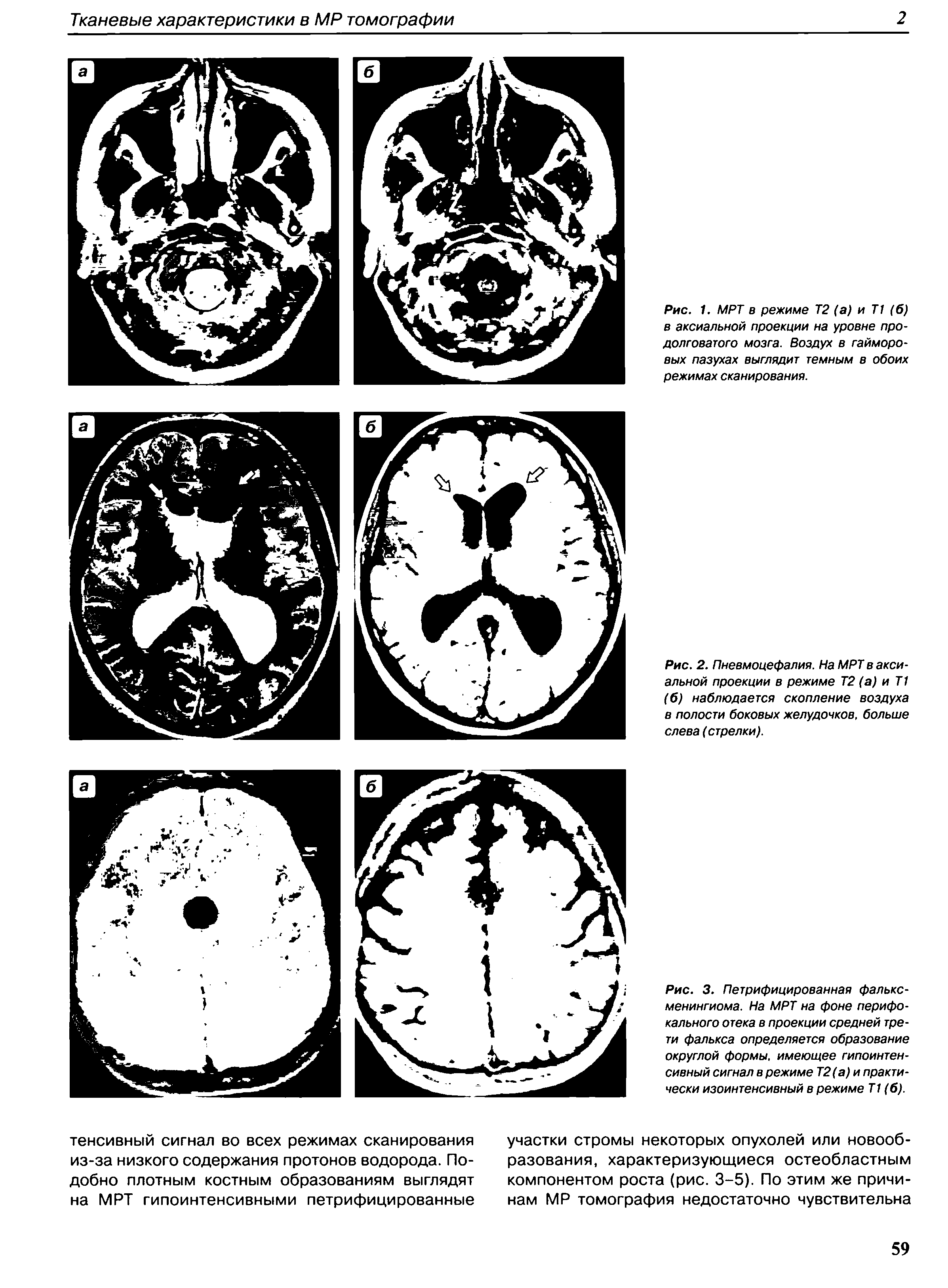 Рис. 3. Петрифицированная фалькс-менингиома. На МРТ на фоне перифокального отека в проекции средней трети фалькса определяется образование округлой формы, имеющее гипоинтен-сивный сигнал в режиме Т2(а) и практически изоинтенсивный в режиме Т1 (б).