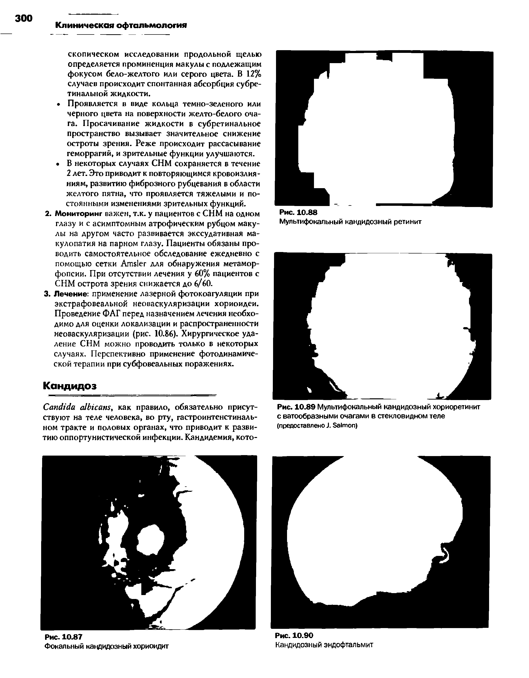 Рис. 10.89 Мультифокальный кандидозный хориоретинит с ватообразными очагами в стекловидном теле (предоставлено J. S )...