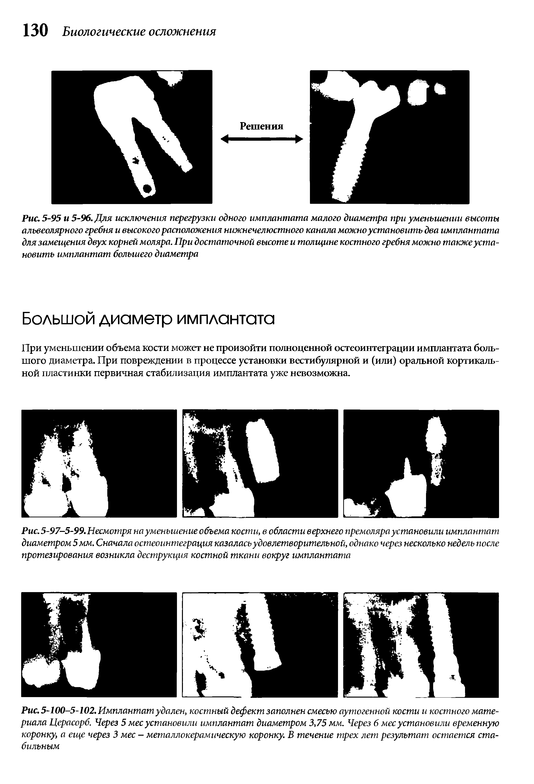 Рис. 5-97-5-99. Несмотря на уменьшение объема кости, в области верхнего премоляра установили имплантат диаметром 5 мм. Сначала остеоинтеграция казалась удовлетворительной, однако через несколько недель после протезирования возникла деструкция костной ткани вокруг имплантата...