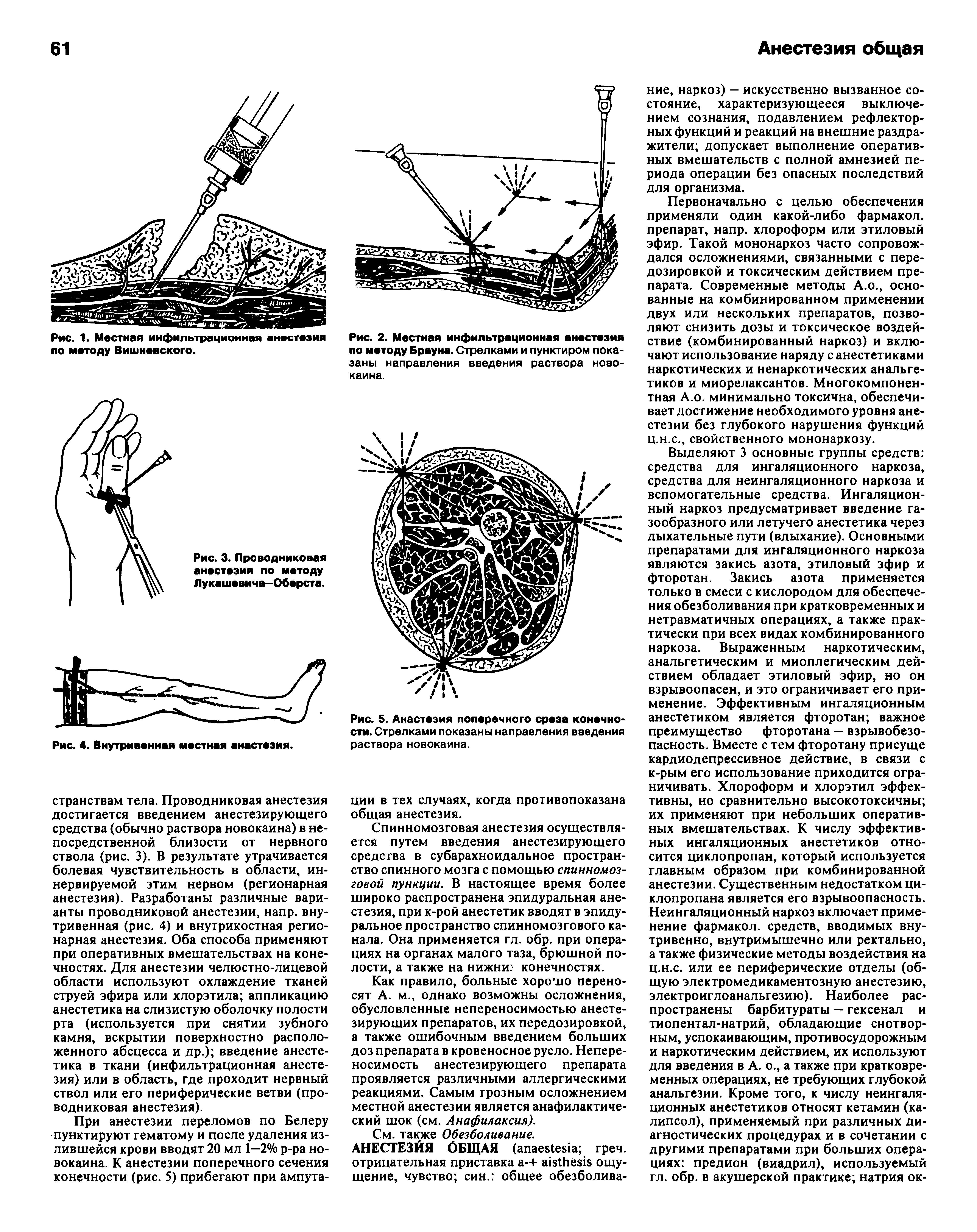 Рис. 2. Местная инфильтрационная анестезия по методу Брауна. Стрелками и пунктиром показаны направления введения раствора новокаина.