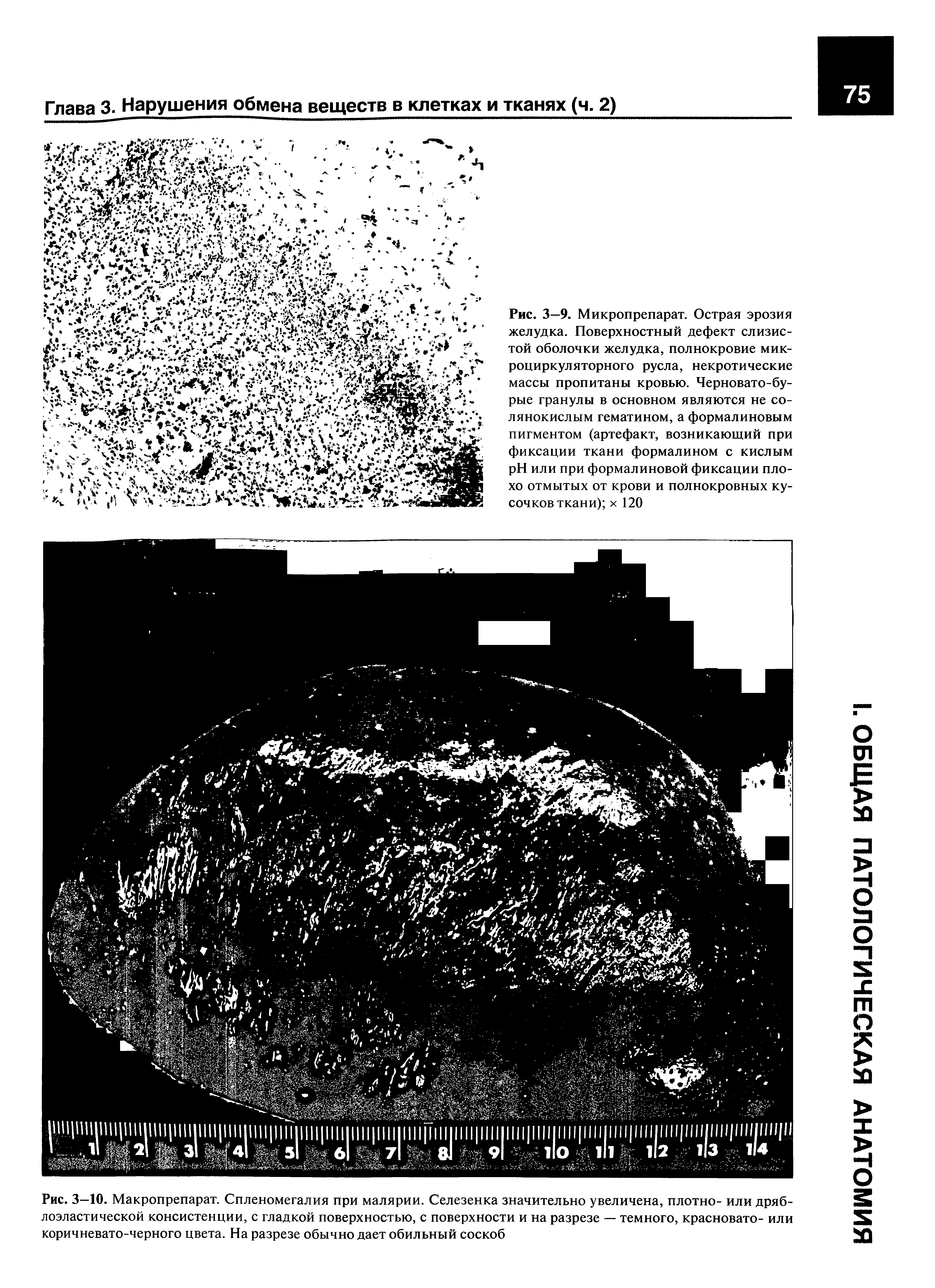 Рис. 3—10. Макропрепарат. Спленомегалия при малярии. Селезенка значительно увеличена, плотно- или дряблоэластической консистенции, с гладкой поверхностью, с поверхности и на разрезе — темного, красновато- или коричневато-черного цвета. На разрезе обычно дает обильный соскоб...