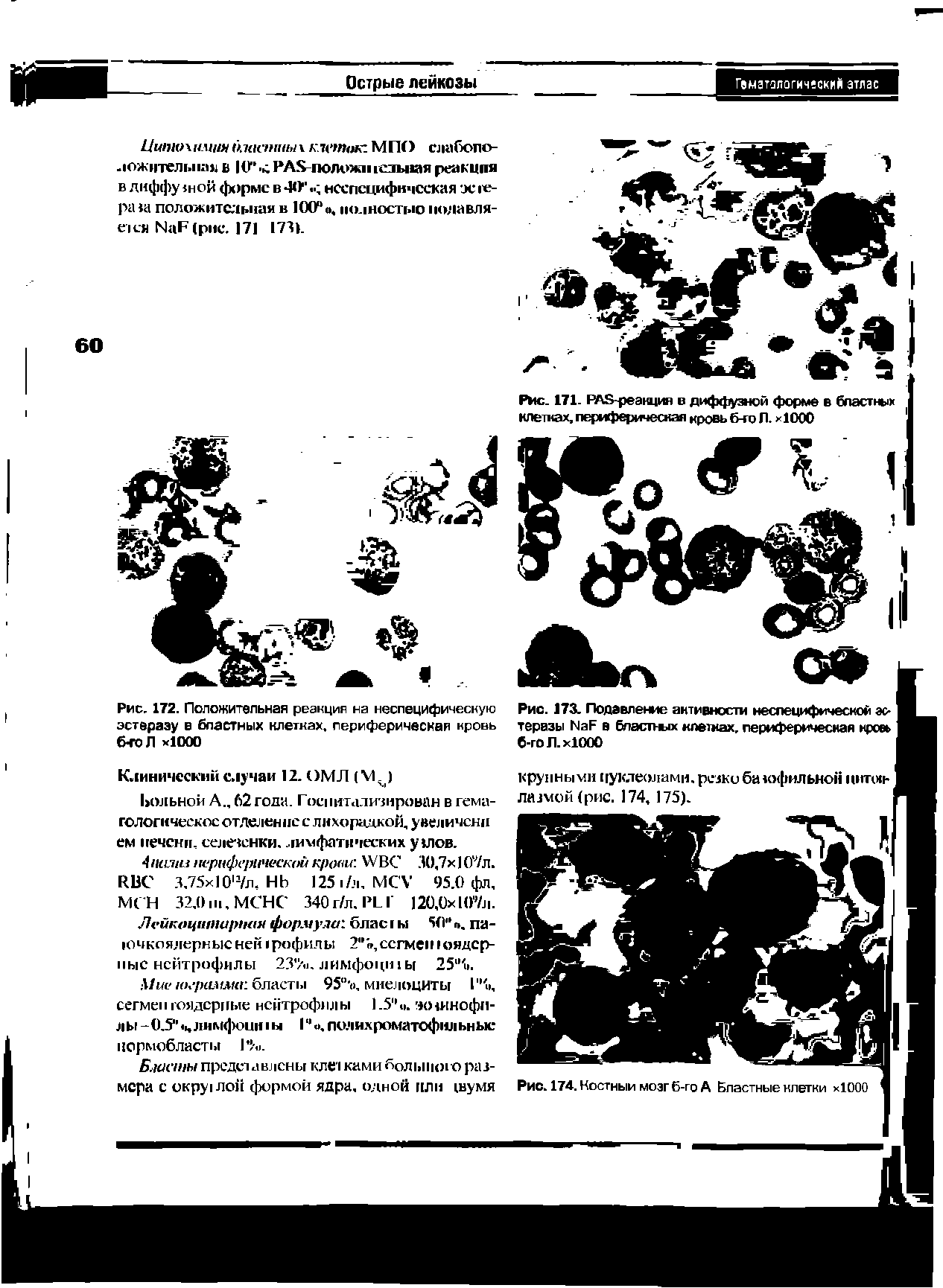 Рис. 171. РА реакция в диффузной форме в бластных клетках, периферическая кровь б-го Л. >1000...