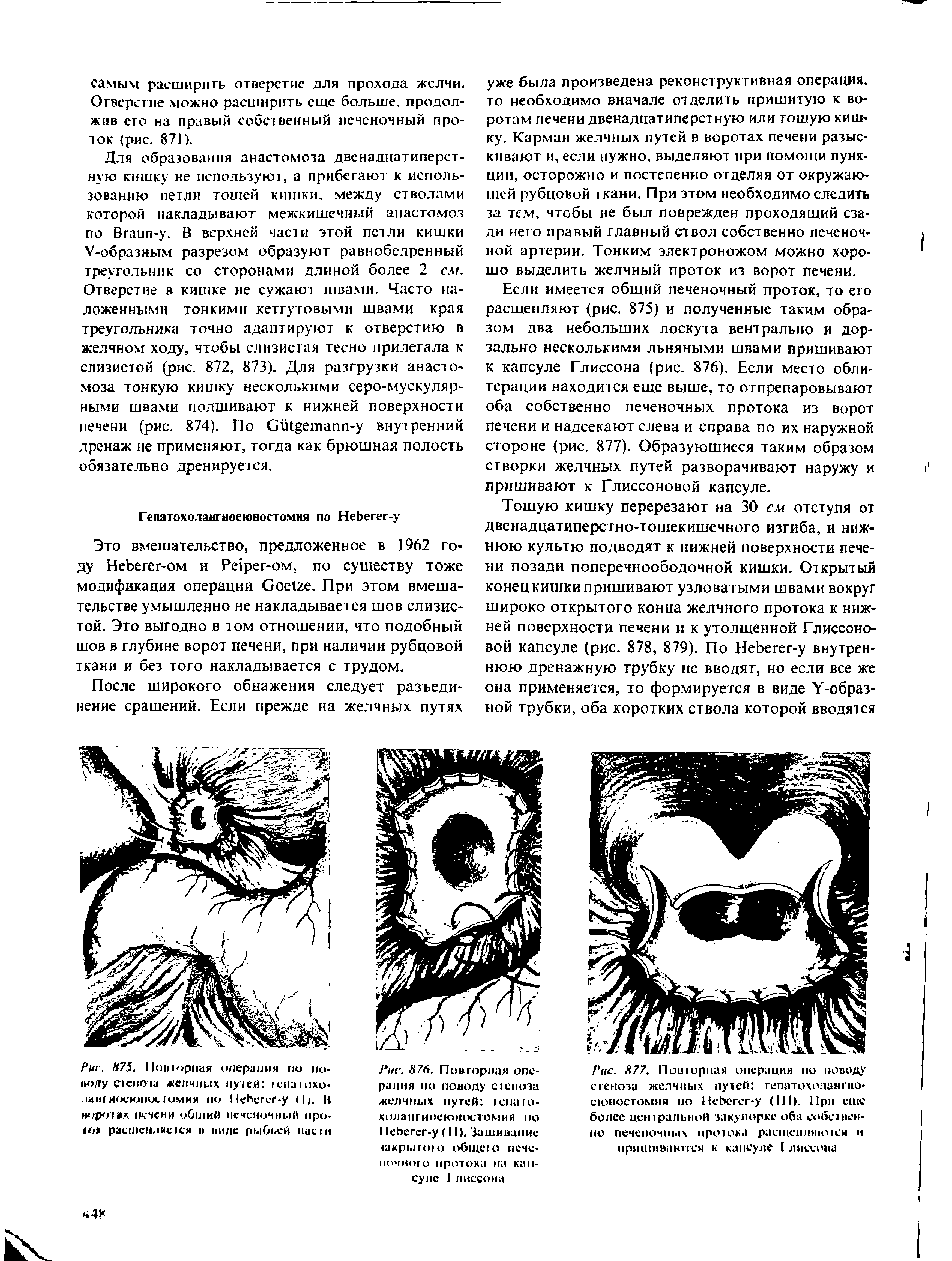 Рис. 877. Повторная операция по поводу стеноза желчных путей гепатохолангно-сюностомня по НеЬсгсг-у (111). При еше более центральной закупорке оба собственно печеночных протока расщепляю 1ся и пришиваю гея к капсуле Глиссона...