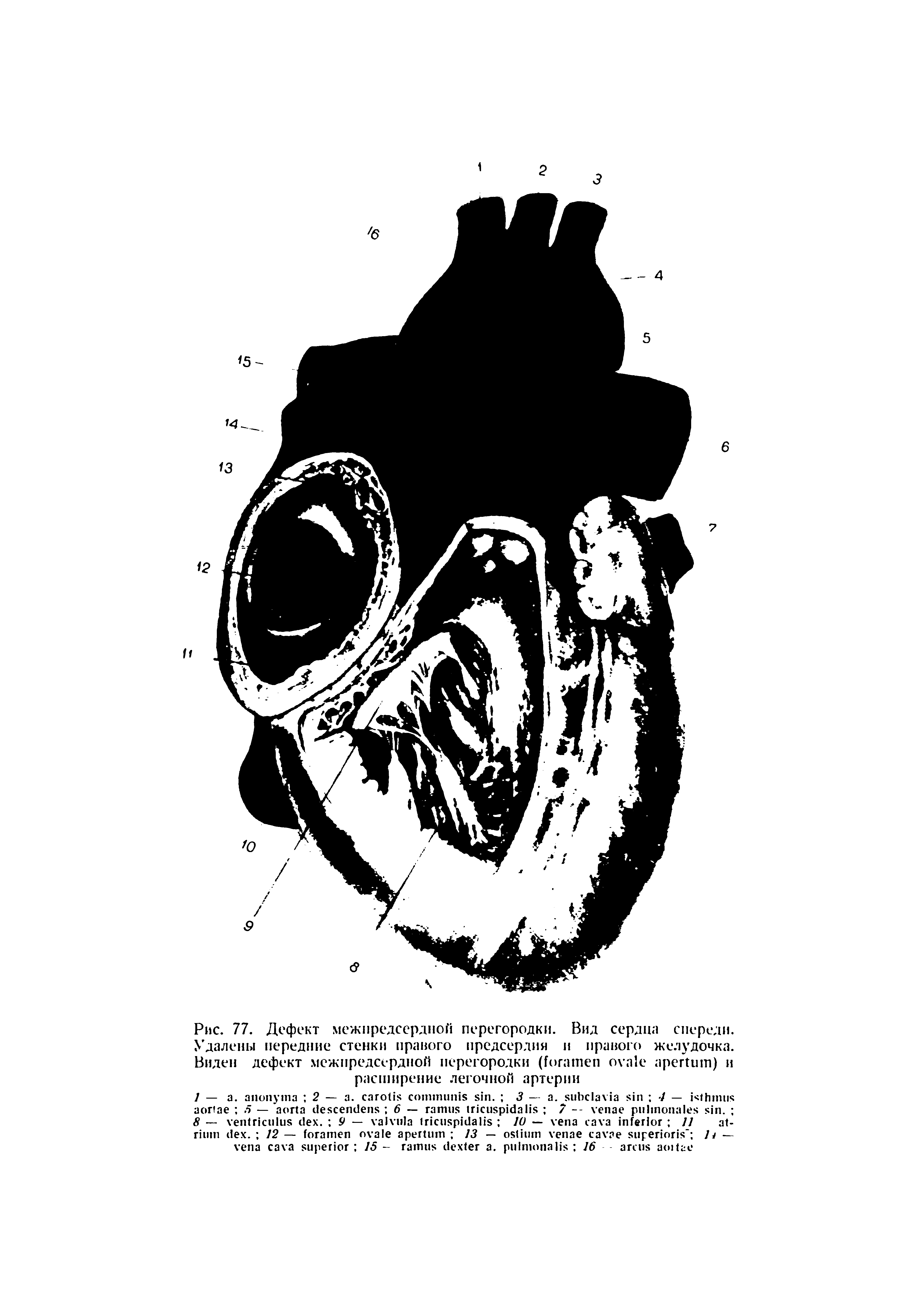 Рис. 77. Дефект межпредсердной перегородки. Вид сердца спереди. Удалены передние стенки правого предсердия и правого желудочка. Виден дефект межпредсердной перегородки ( ) и расширение легочной артерии...