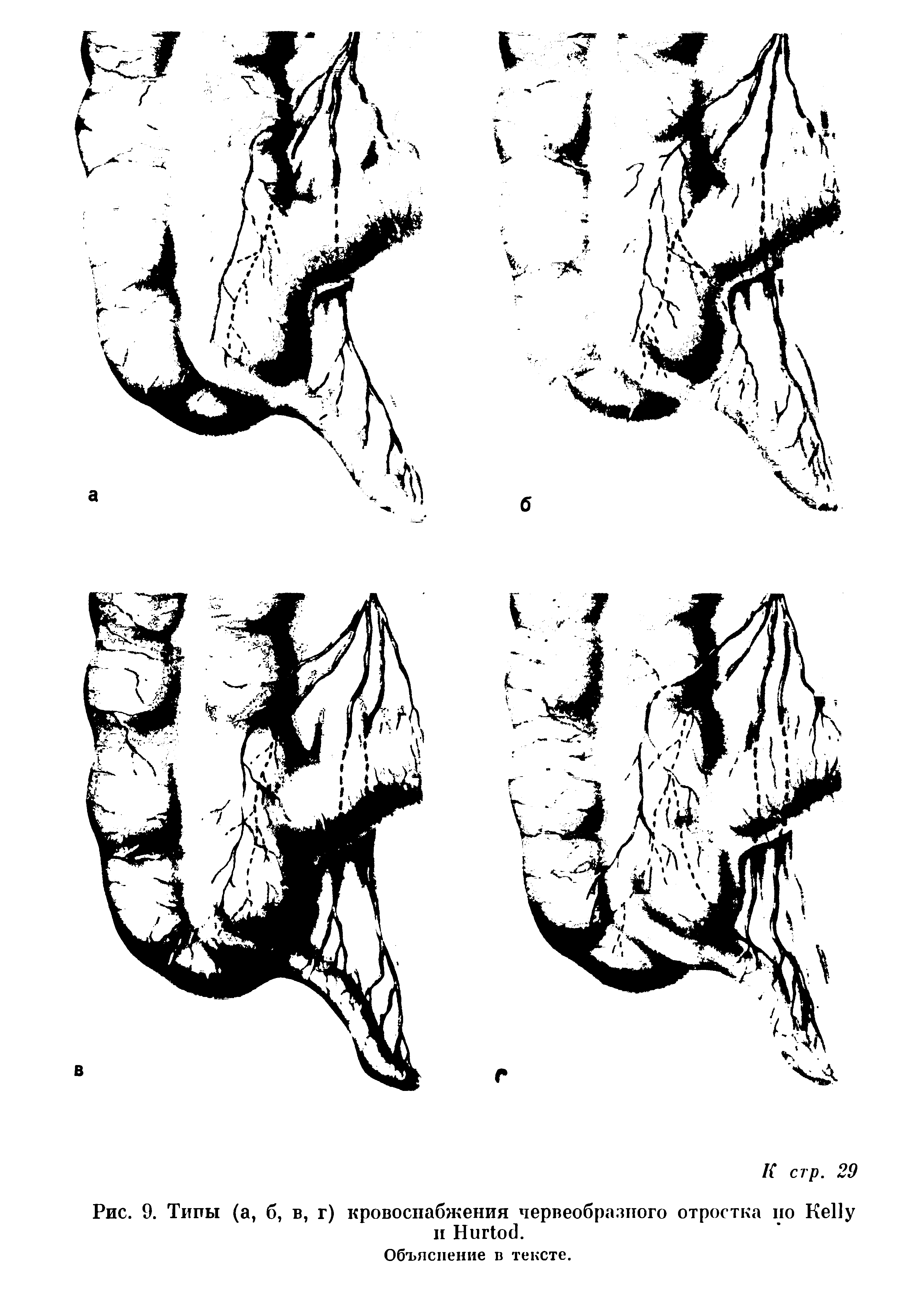 Рис. 9. Типы (а, б, в, г) кровоснабжения червеобразного отростка но Ке11у н НиНос .