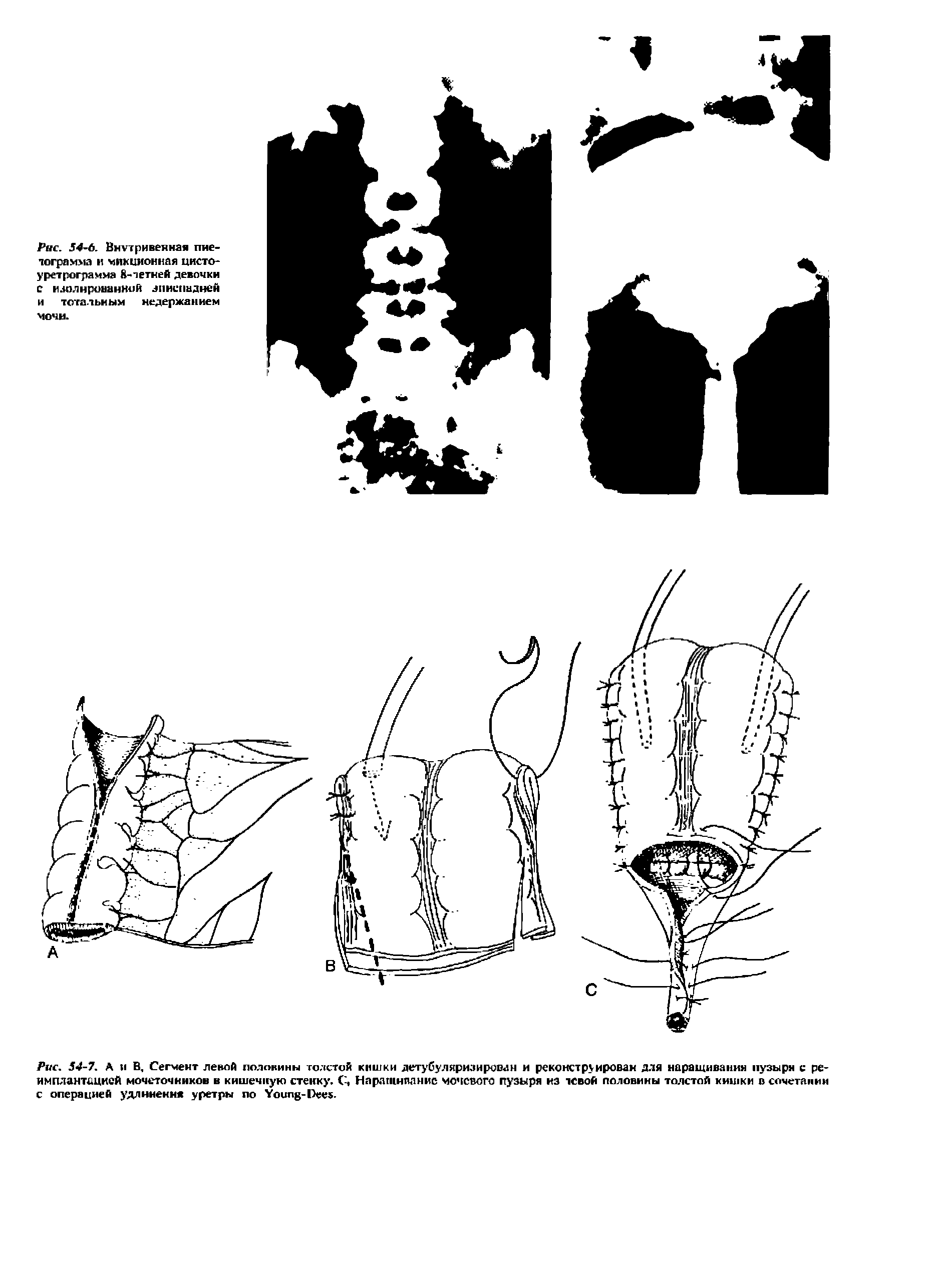 Рис. 54-7. А и В, Сегмент левой половины толстой кишки детубуляризирооан и реконструирован для наращивании пузыри с реимплантацией мочеточников в кишечную стенку. С-, Наращивание мочевого пузыря из левой половины толстой кишки в сочетании с операцией удлинения уретры по Y -D .
