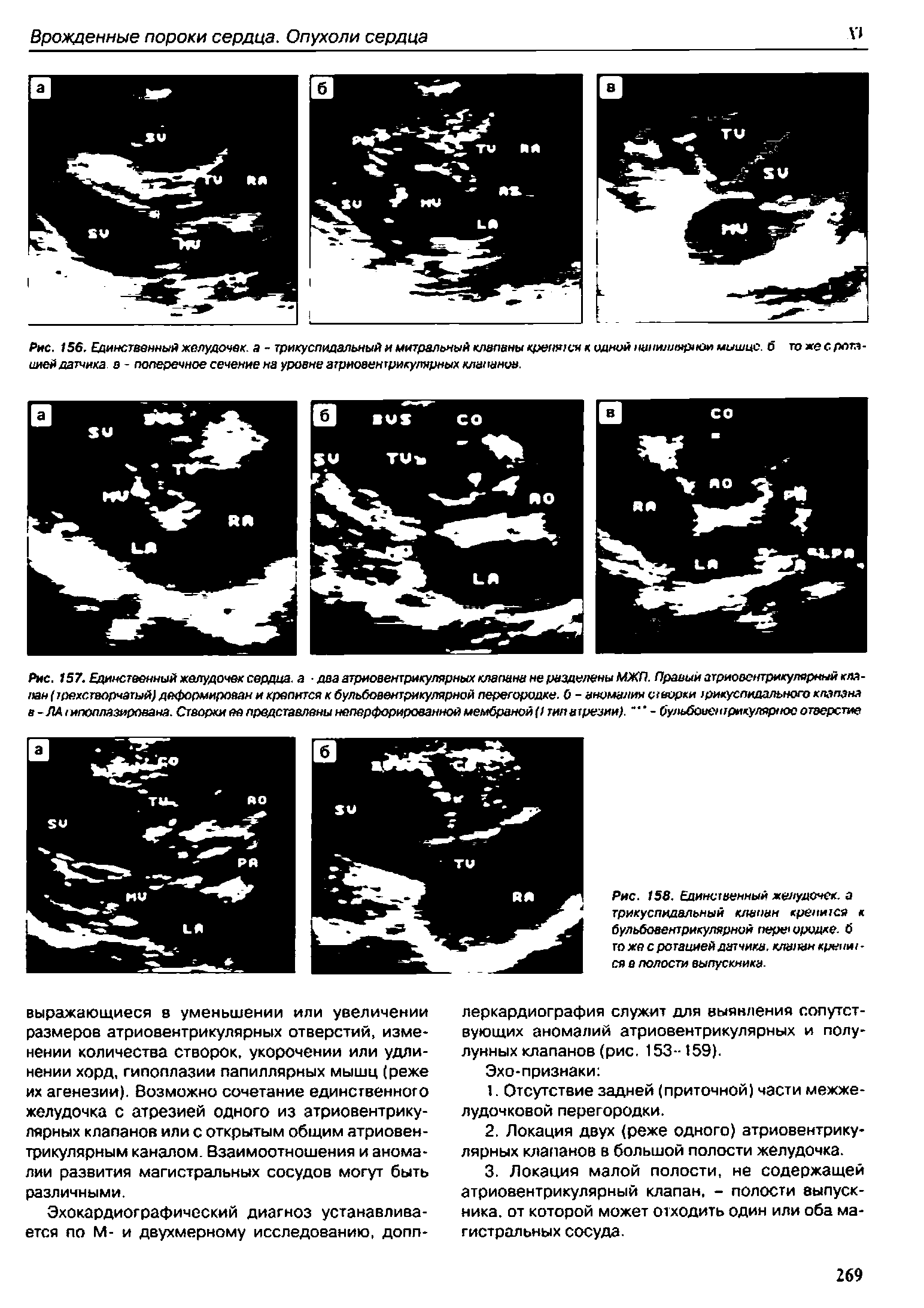 Рис. 157. Единственный желудочек сердца, а два атриовентрикулярных клапана не разделены МЖП. Правый атриовентрикулярный клапан (трехстворчатый деформирован и крепится к бульбовентрикулярной перегородке, б - аномалия створки трикуспидального клапана в-ЛА типоплазирована. Створки ее представлены неперфорированной мембраной () типатрезии). - бульбоаентрнкупарное отверстие...