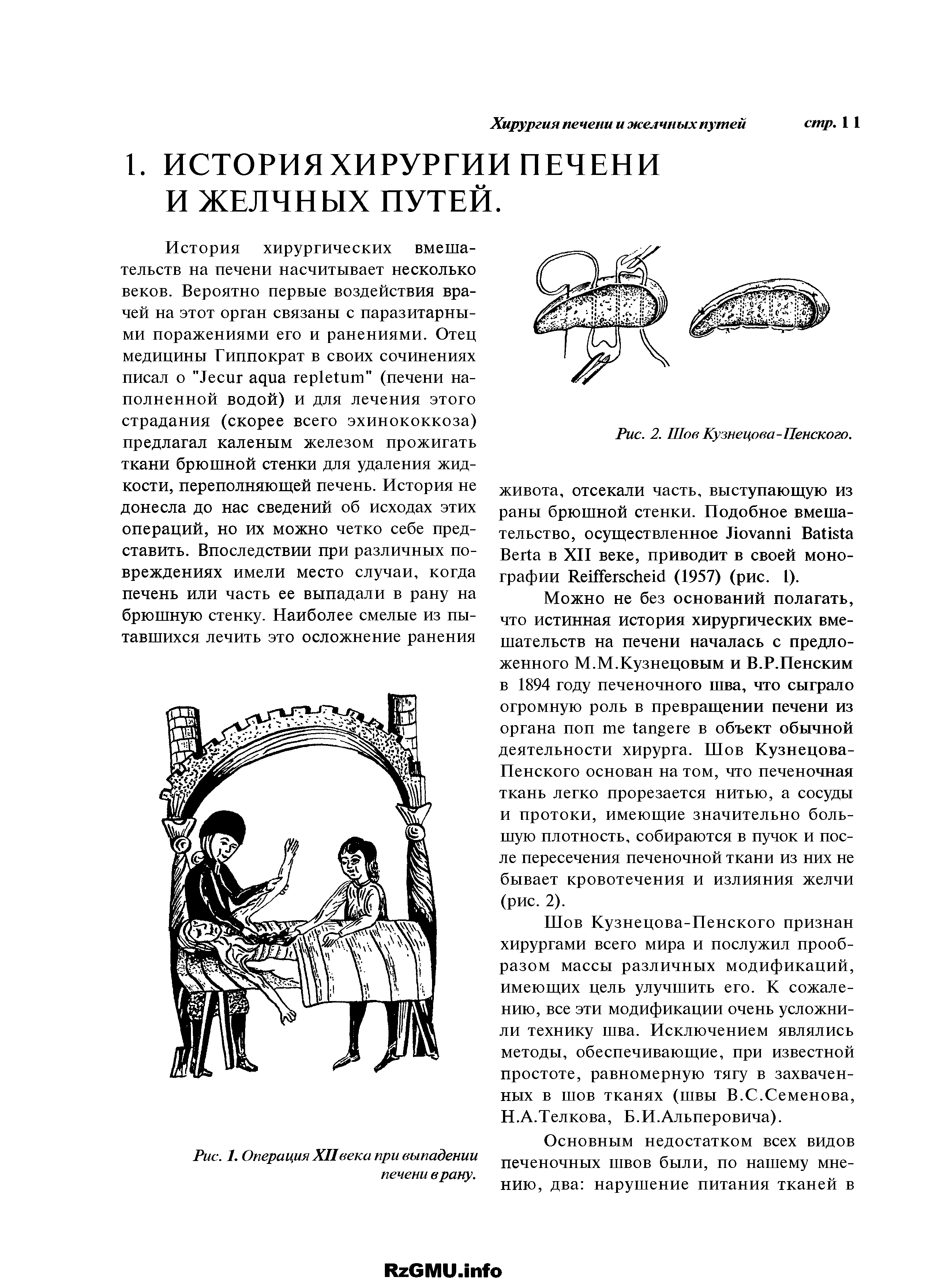 Рис. 2. Шов Кузнецова-Пенского. живота, отсекали часть, выступающую из раны брюшной стенки. Подобное вмешательство, осуществленное J B B в XII веке, приводит в своей монографии R (1957) (рис. 1).