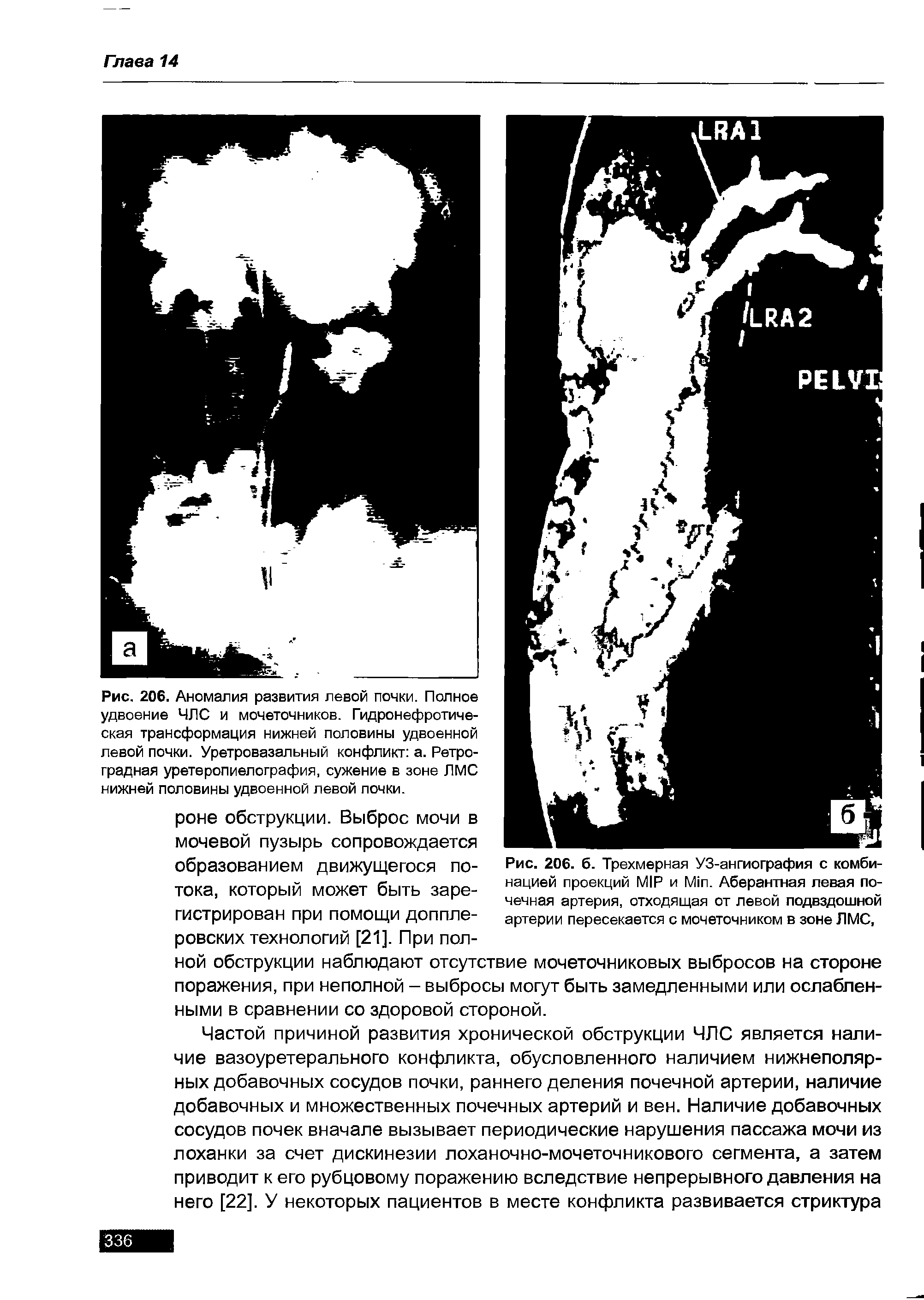 Рис. 206. 6. Трехмерная УЗ-ангиография с комбинацией проекций MIR и M . Аберантная левая почечная артерия, отходящая от левой подвздошной артерии пересекается с мочеточником в зоне ЛМС,...