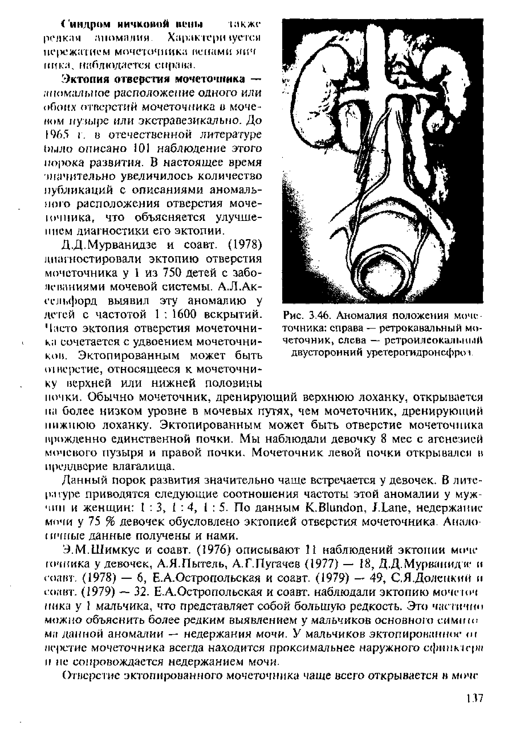 Рис. 3.46. Аномалия положения мочеточника справа — ретрокавальный мочеточник, слева — ретроилеокальный двусторонний уретерогидронефро г...