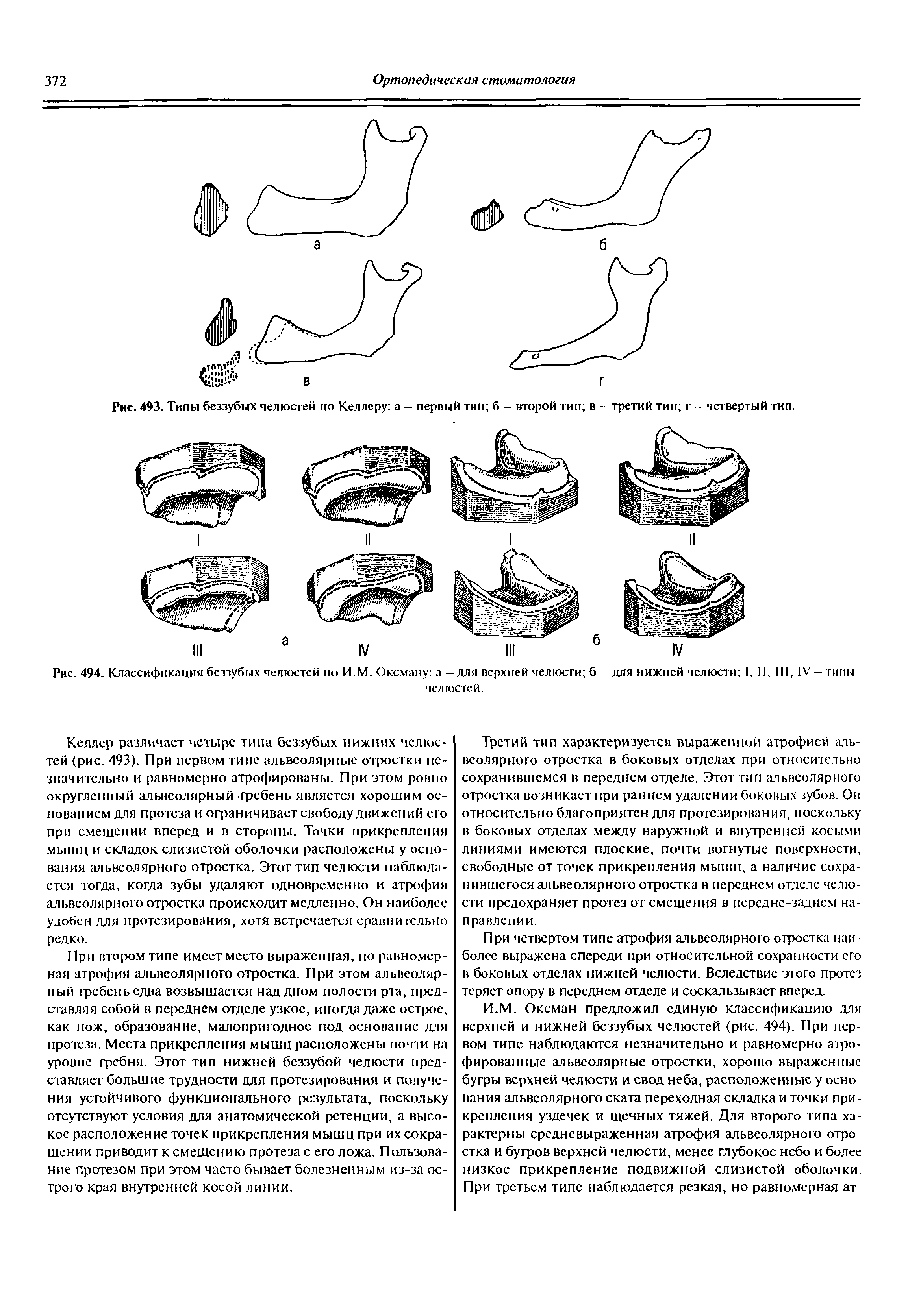 Рис. 494. Классификация беззубых челюстей по И.М. Оксману а - для верхней челюсти б - для нижней челюсти I. II. I , IV - типы челюстей.