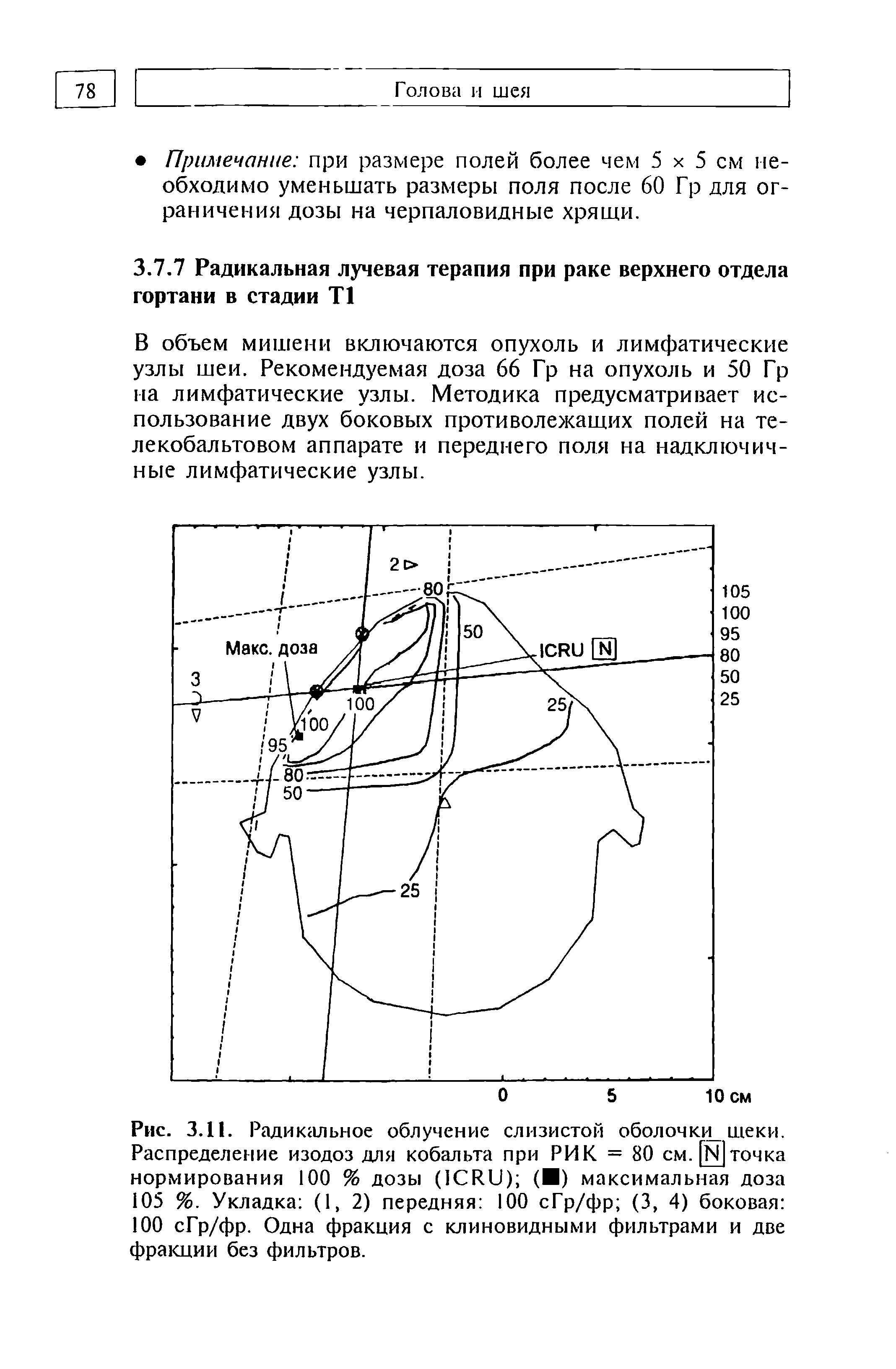 Рис. 3.11. Радикальное облучение слизистой обол очки щеки. Распределение изодоз для кобальта при РИК = 80 см. [N]точка нормирования 100 % дозы (ICRU) ( ) максимальная доза 105 %. Укладка (1, 2) передняя 100 сГр/фр (3, 4) боковая 100 сГр/фр. Одна фракция с клиновидными фильтрами и две фракции без фильтров.